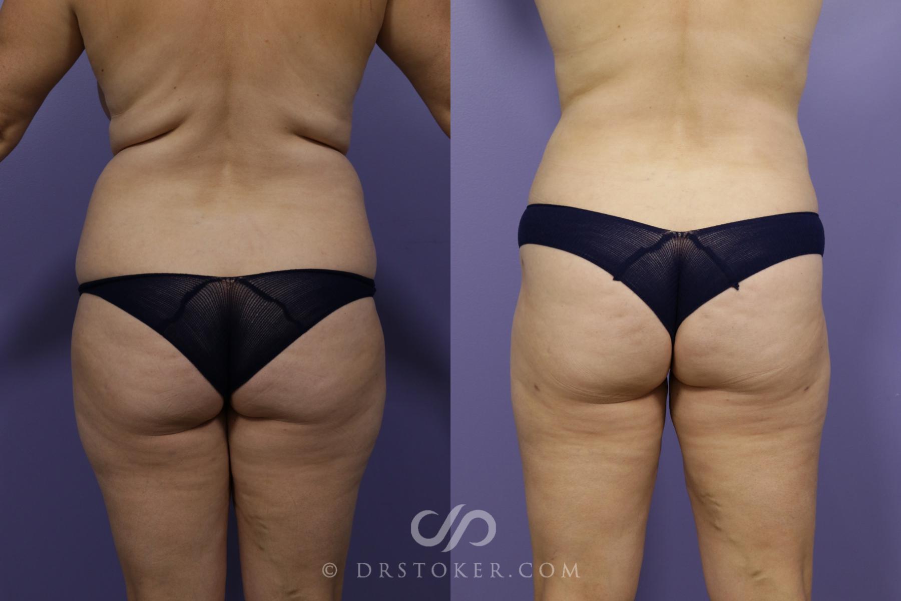 Before & After Liposuction Case 1320 View #2 View in Los Angeles, CA