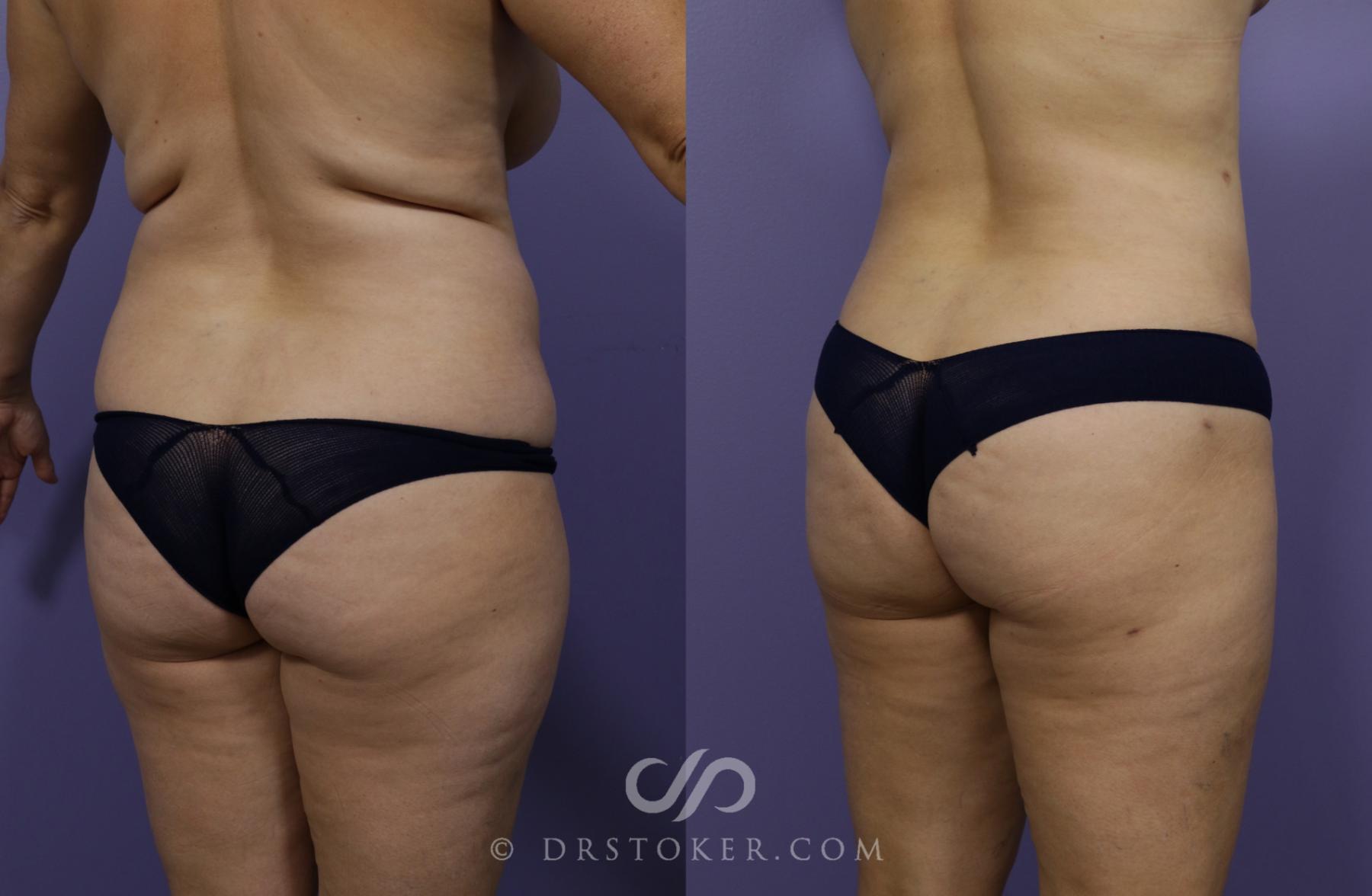 Before & After Liposuction Case 1320 View #3 View in Los Angeles, CA