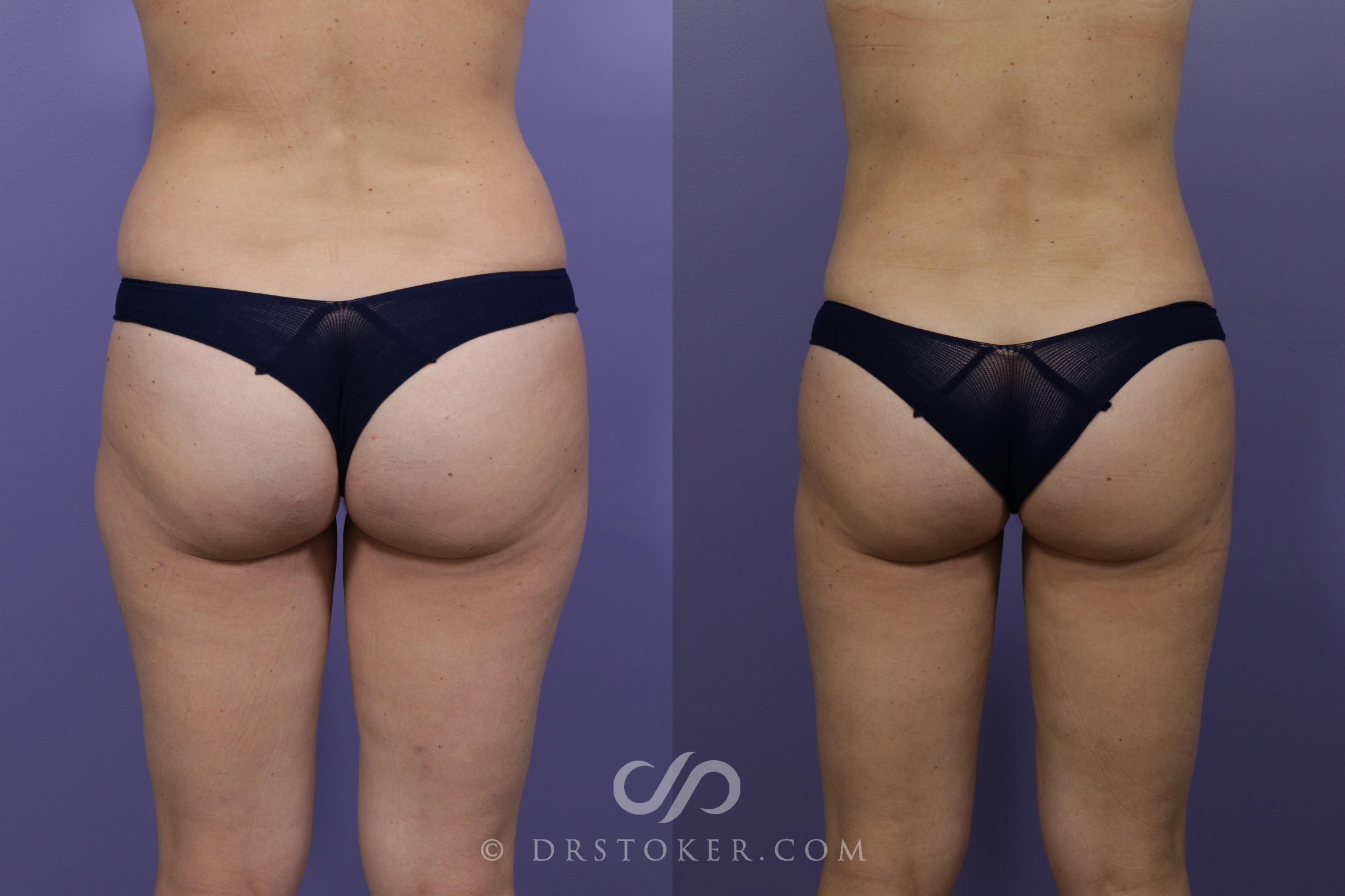 Before & After Liposuction Case 1322 View #1 View in Los Angeles, CA