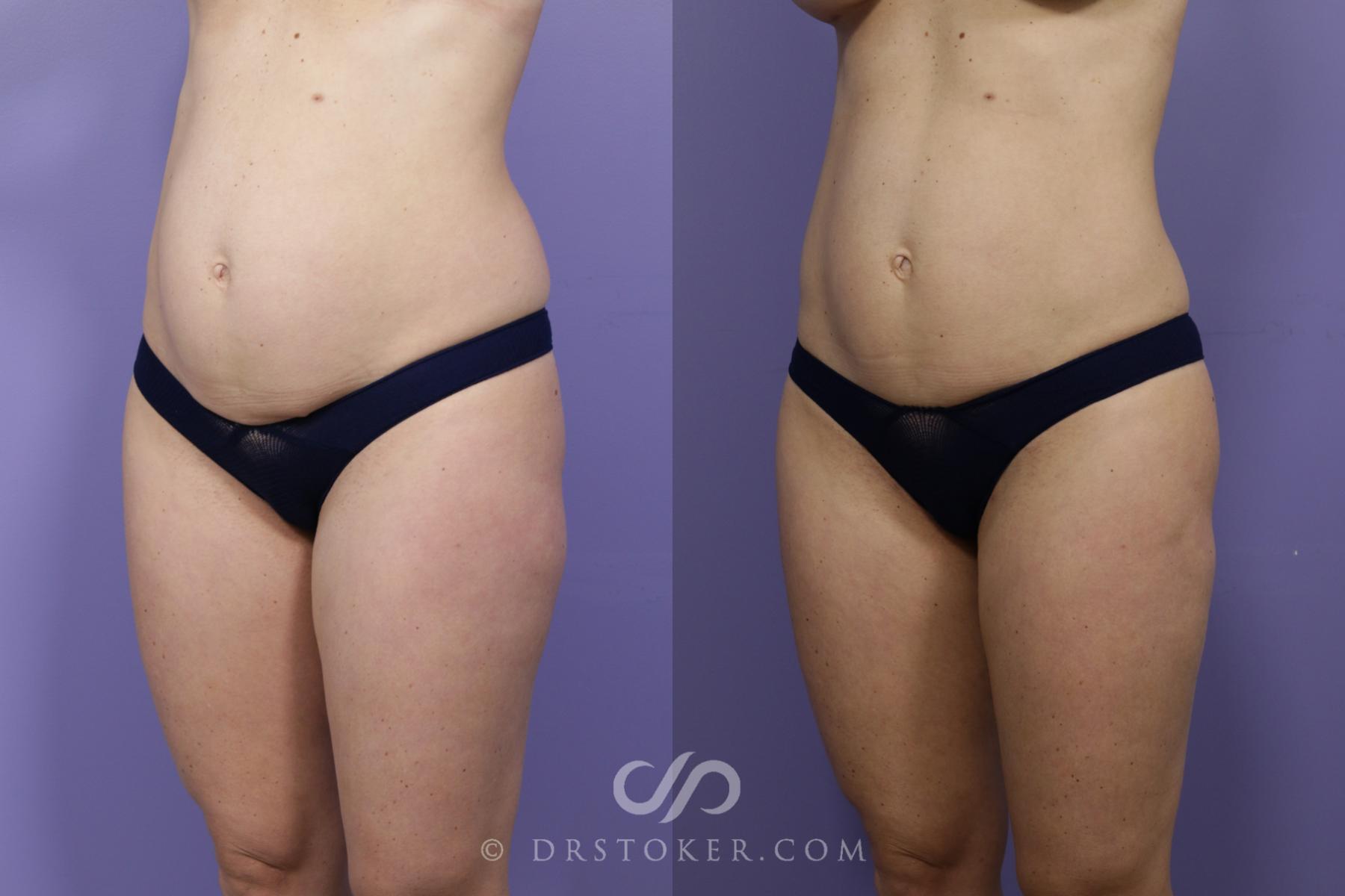 Before & After Liposuction Case 1322 View #2 View in Los Angeles, CA