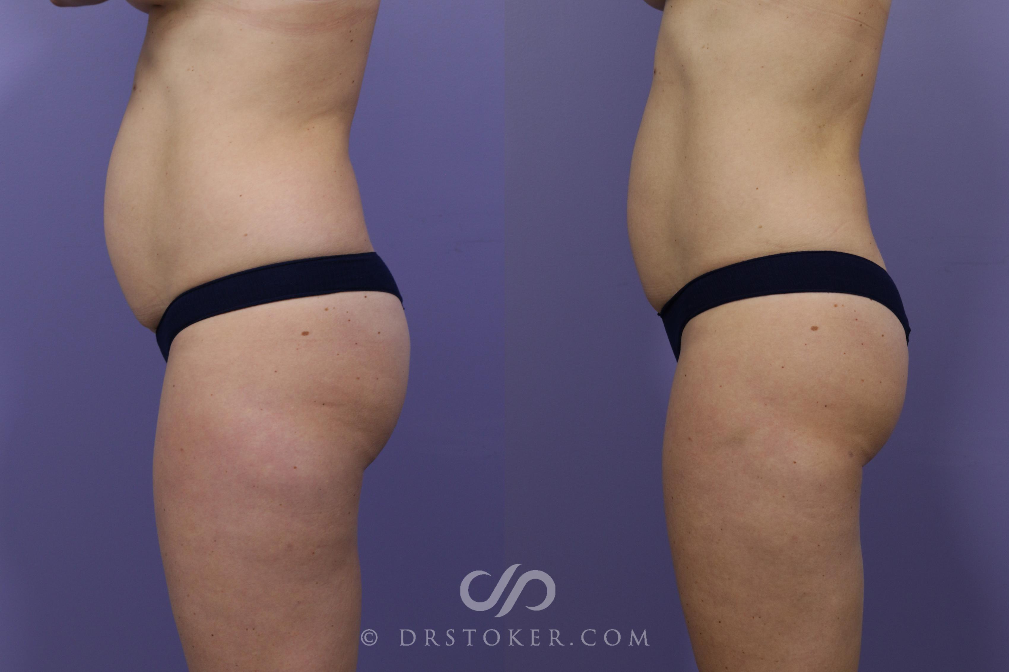 Before & After Liposuction Case 1322 View #3 View in Los Angeles, CA