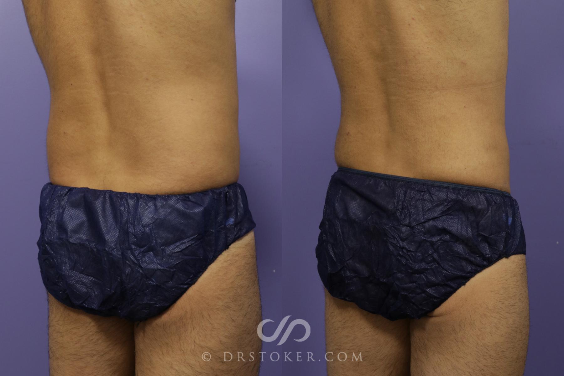 Before & After Liposuction Case 1323 View #1 View in Los Angeles, CA