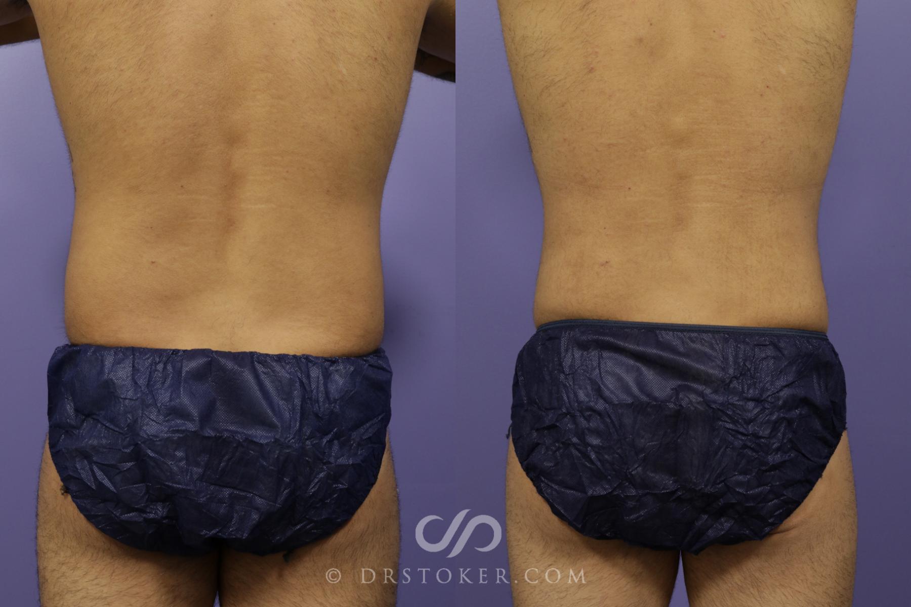 Before & After Liposuction Case 1323 View #2 View in Los Angeles, CA