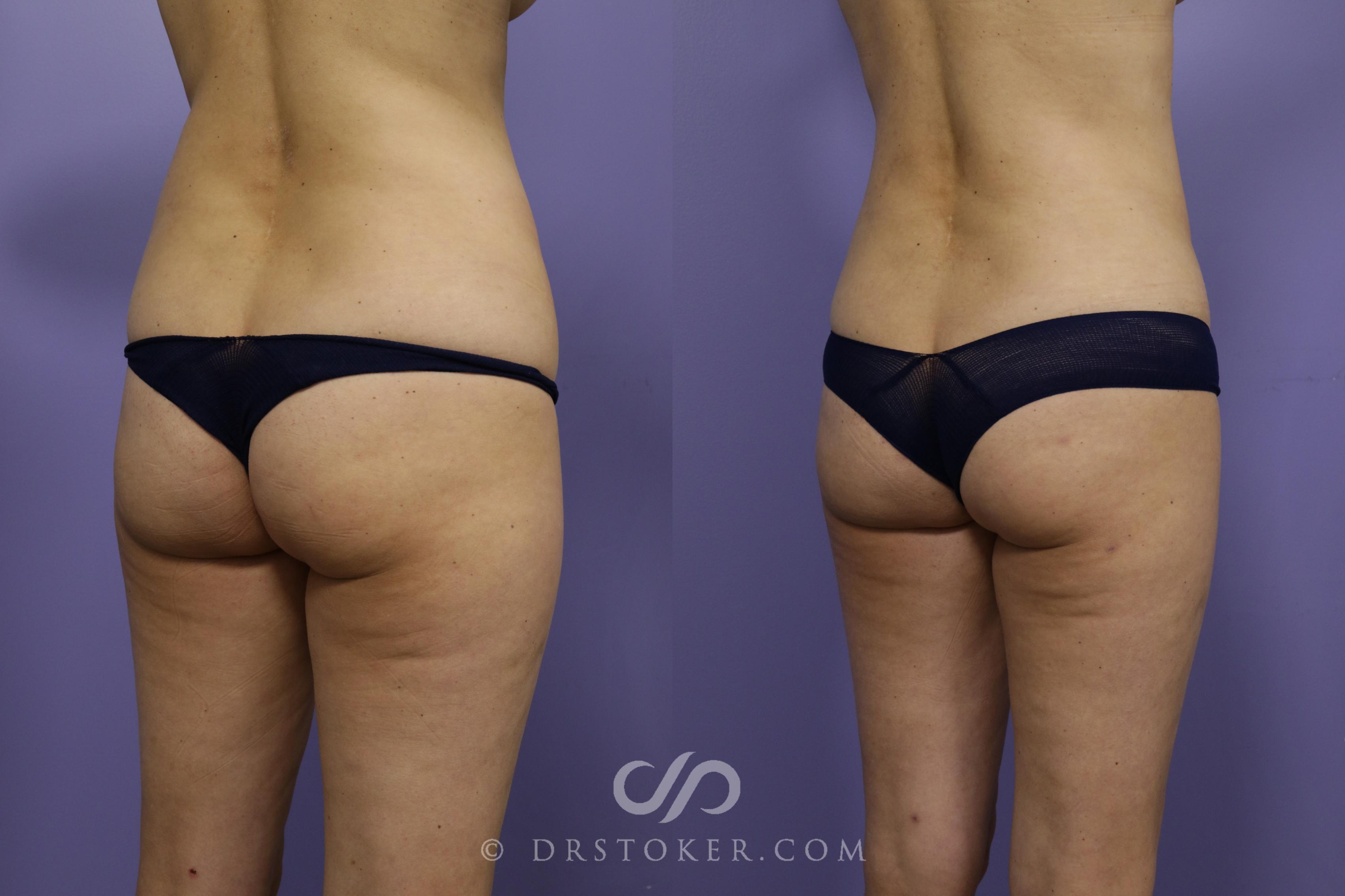 Before & After Liposuction Case 1324 View #1 View in Los Angeles, CA
