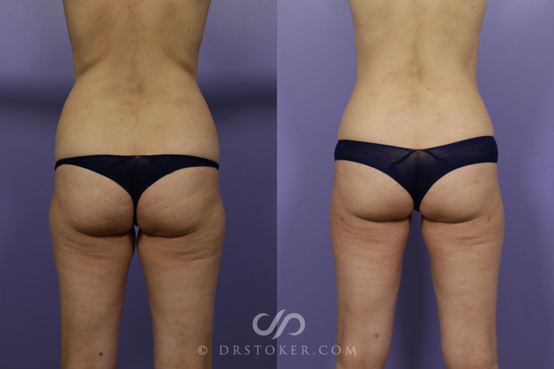 Before & After Liposuction Case 1324 View #2 View in Los Angeles, CA
