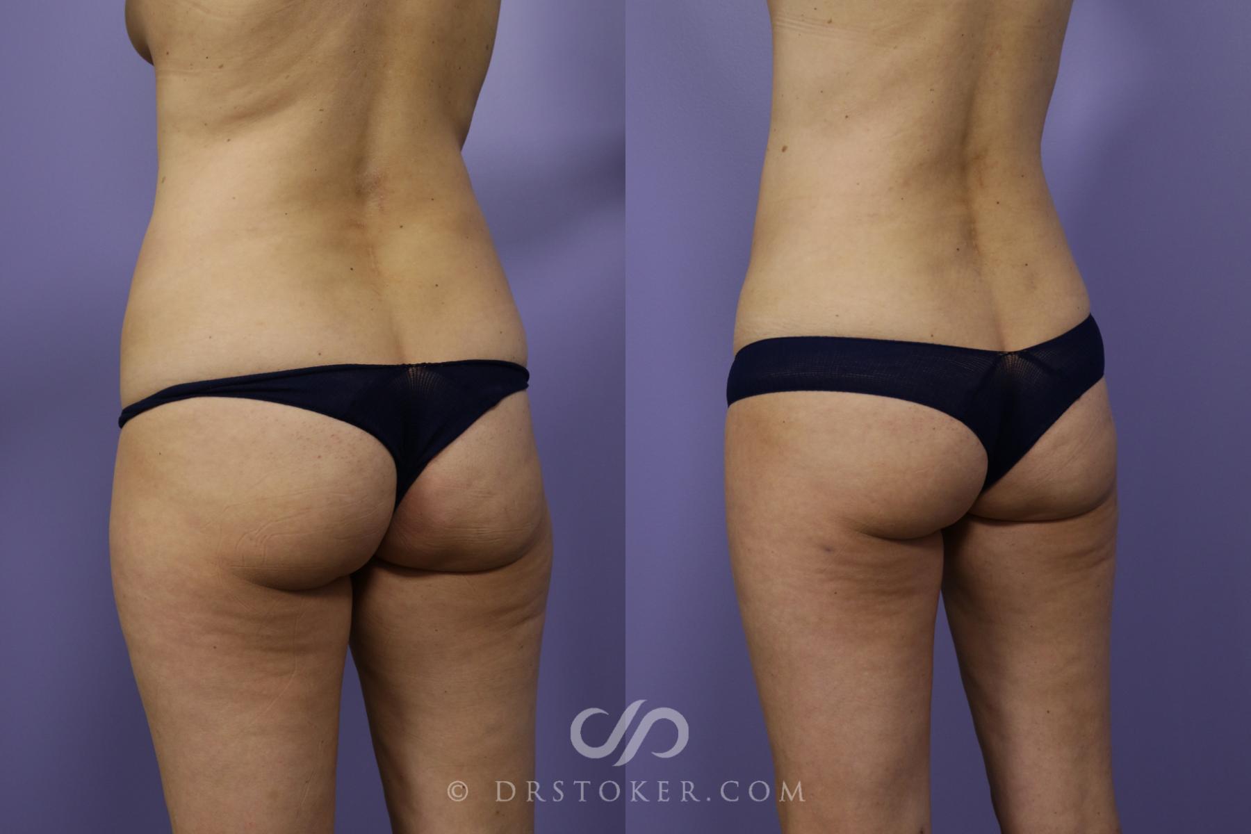 Before & After Liposuction Case 1324 View #3 View in Los Angeles, CA
