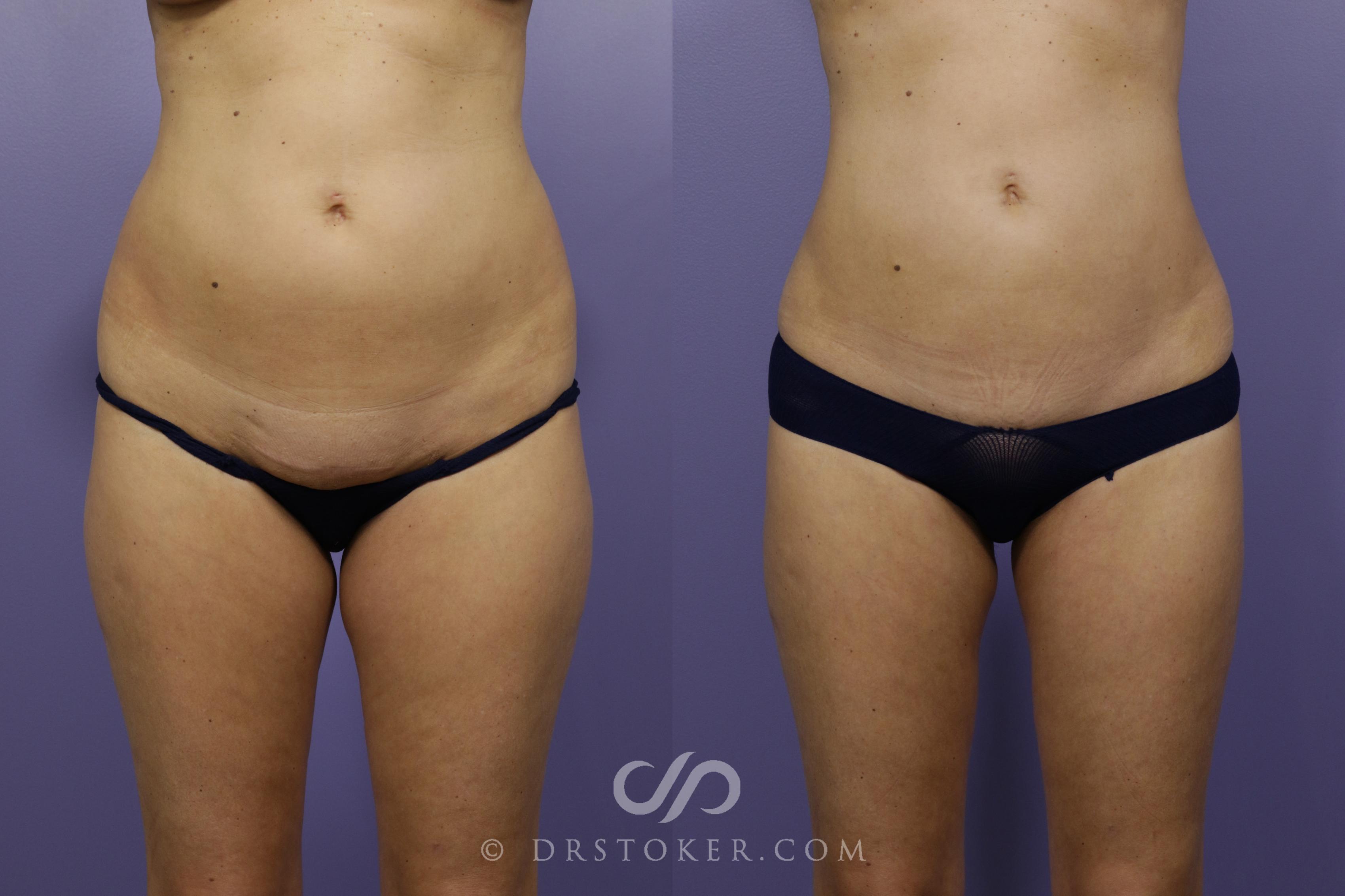 Before & After Liposuction Case 1325 View #1 View in Los Angeles, CA
