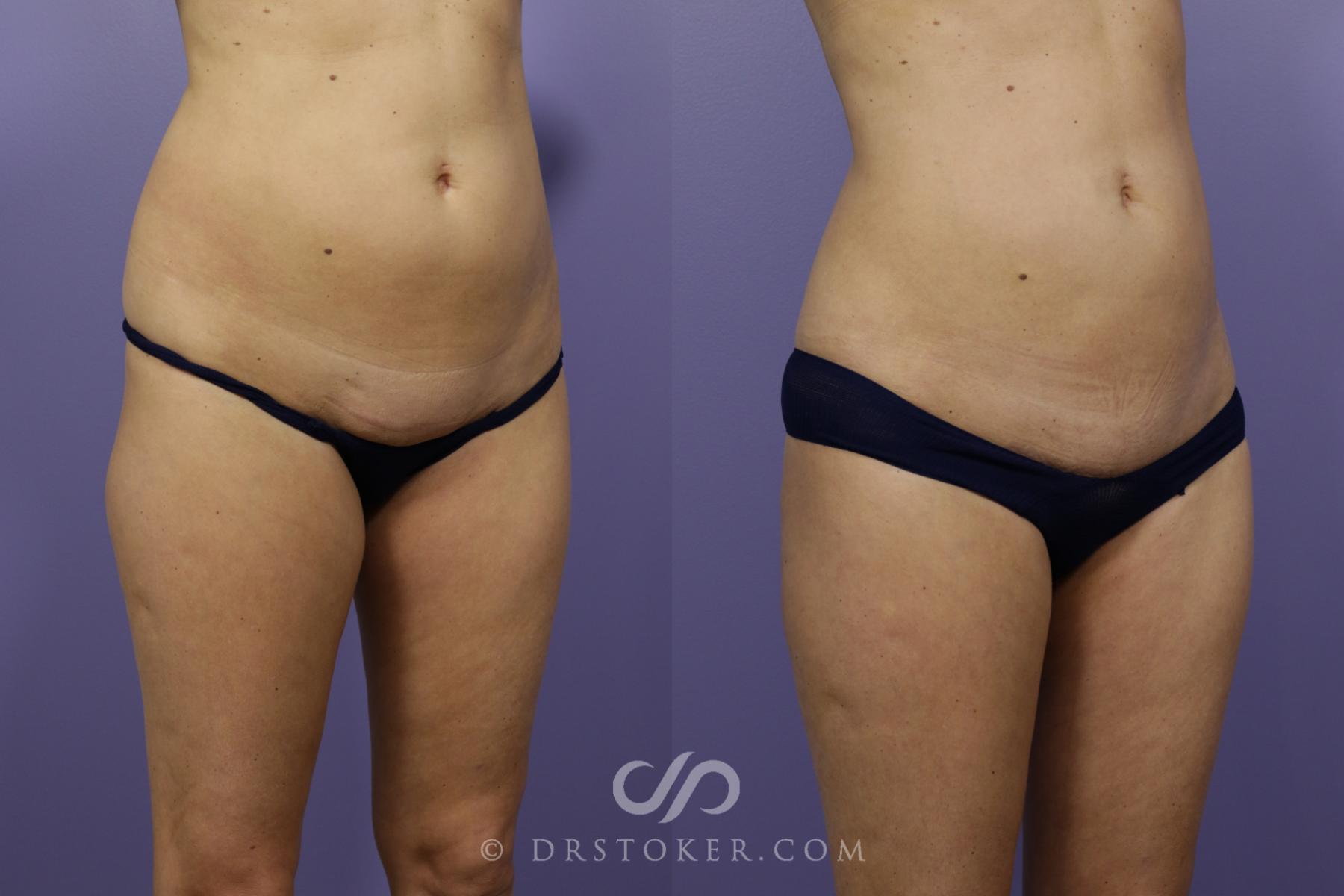 Before & After Liposuction Case 1325 View #2 View in Los Angeles, CA