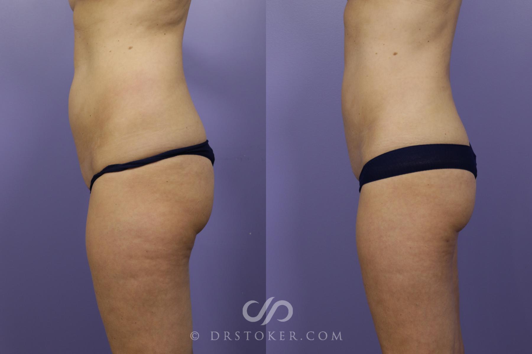 Before & After Liposuction Case 1325 View #3 View in Los Angeles, CA
