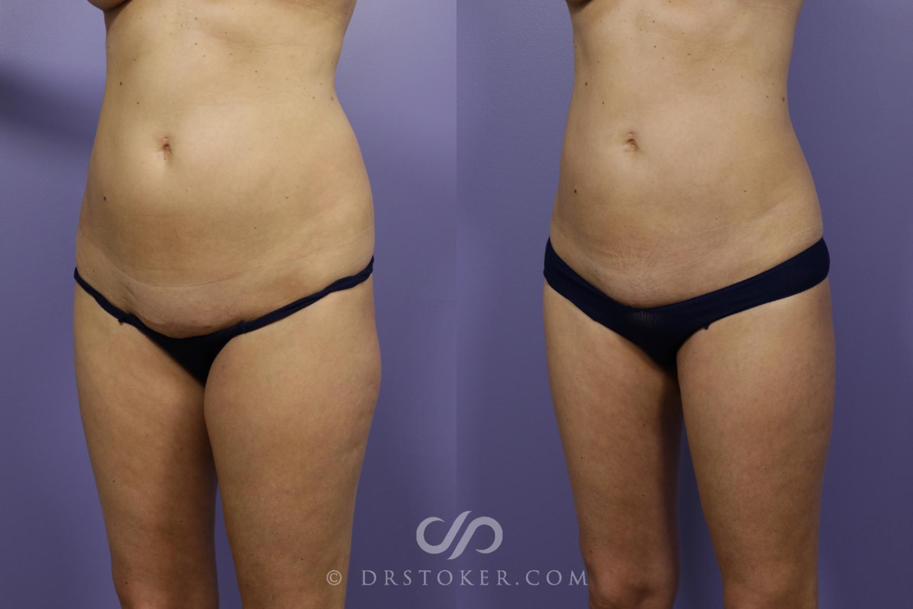 Before & After Liposuction Case 1325 View #4 View in Los Angeles, CA