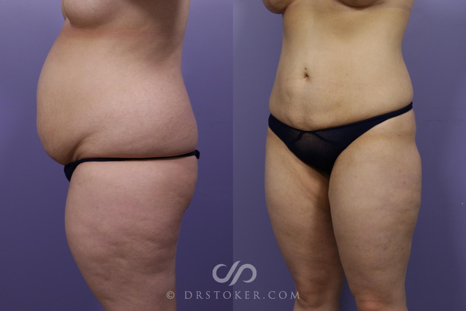 Before & After Liposuction Case 1326 View #1 View in Los Angeles, CA