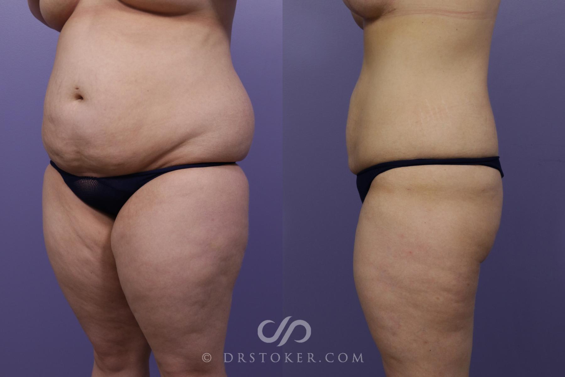 Before & After Liposuction Case 1326 View #2 View in Los Angeles, CA