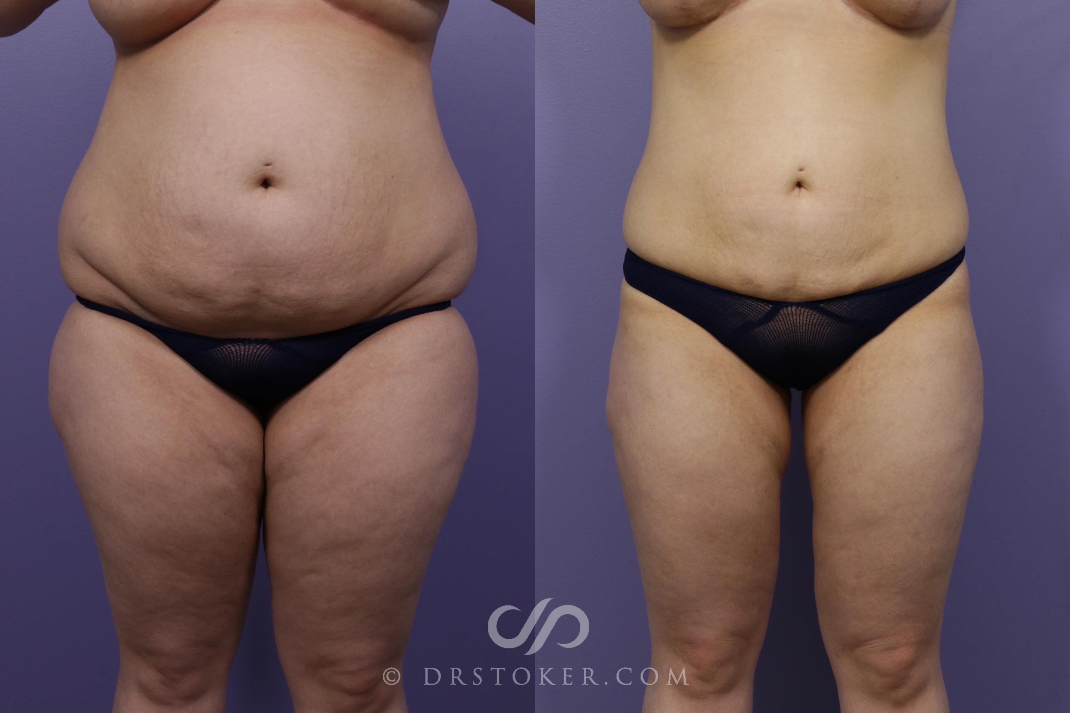 Before & After Liposuction Case 1327 View #1 View in Los Angeles, CA