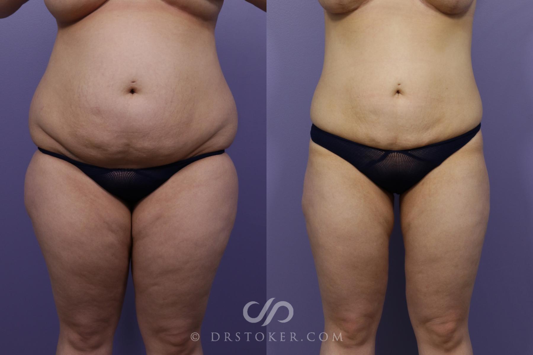 Before & After Liposuction Case 1327 View #1 View in Los Angeles, CA