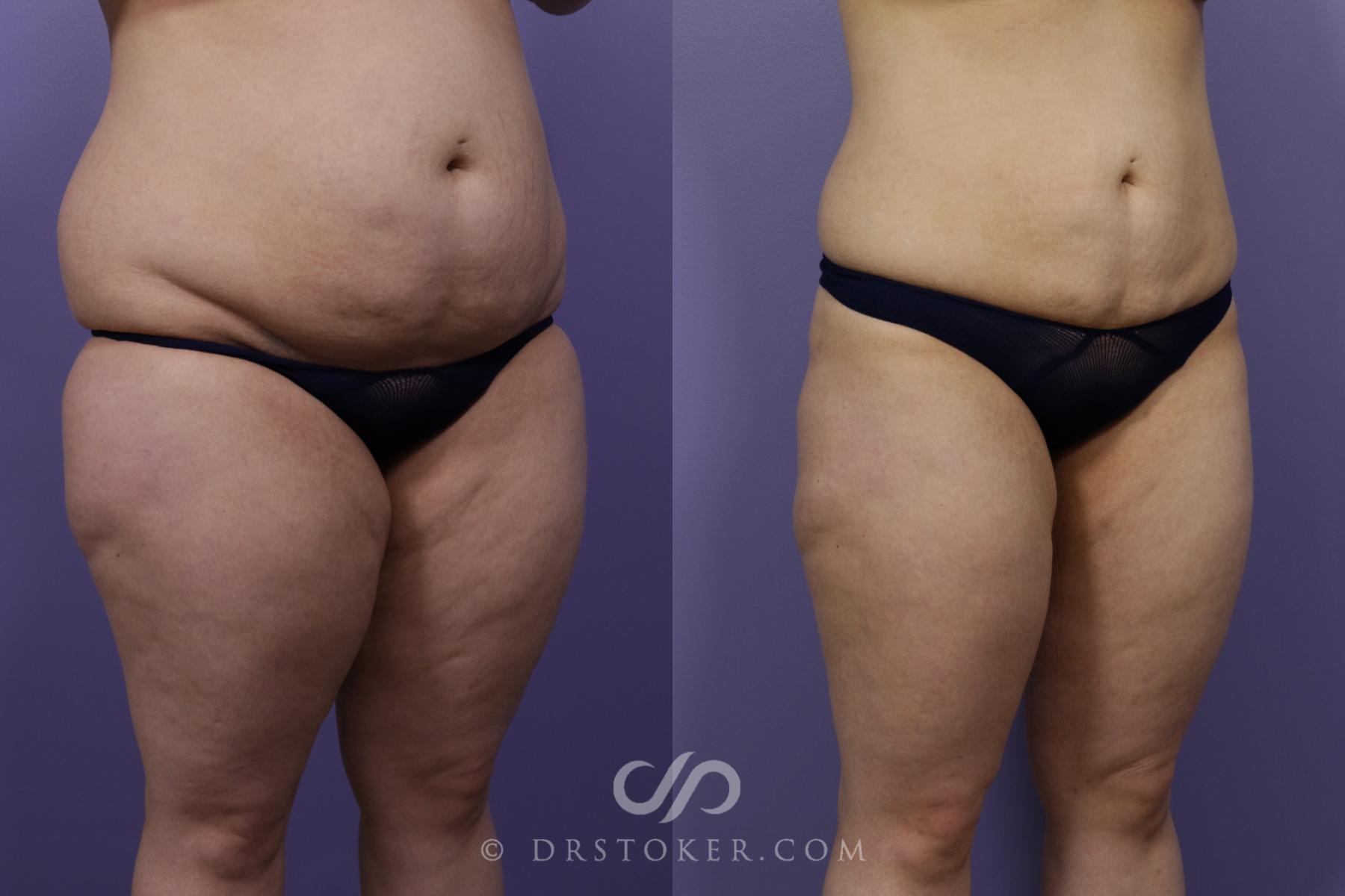 Before & After Liposuction Case 1327 View #2 View in Los Angeles, CA