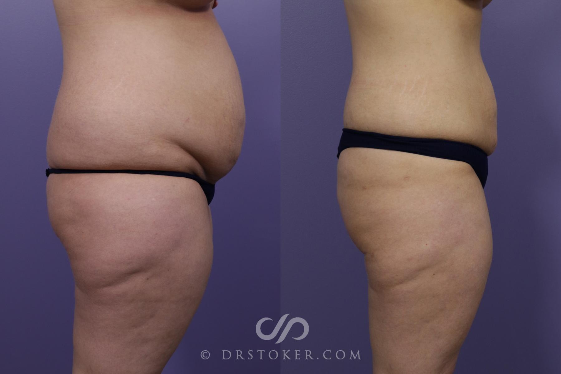 Before & After Liposuction Case 1327 View #3 View in Los Angeles, CA