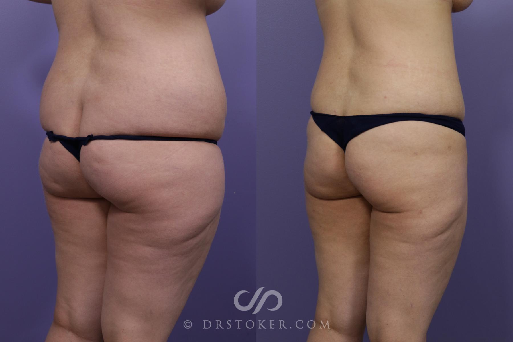 Before & After Liposuction Case 1328 View #1 View in Los Angeles, CA