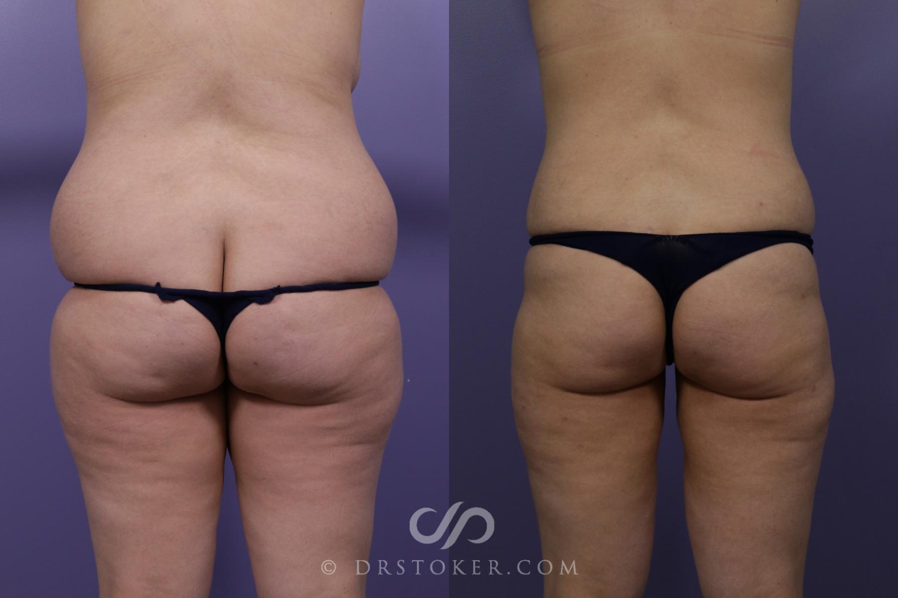 Before & After Liposuction Case 1328 View #2 View in Los Angeles, CA