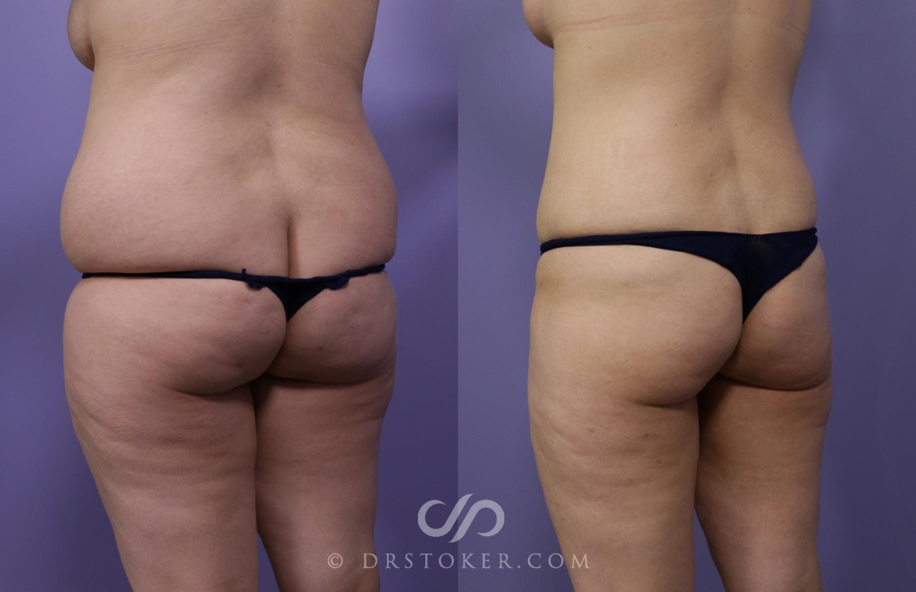 Before & After Liposuction Case 1328 View #3 View in Los Angeles, CA