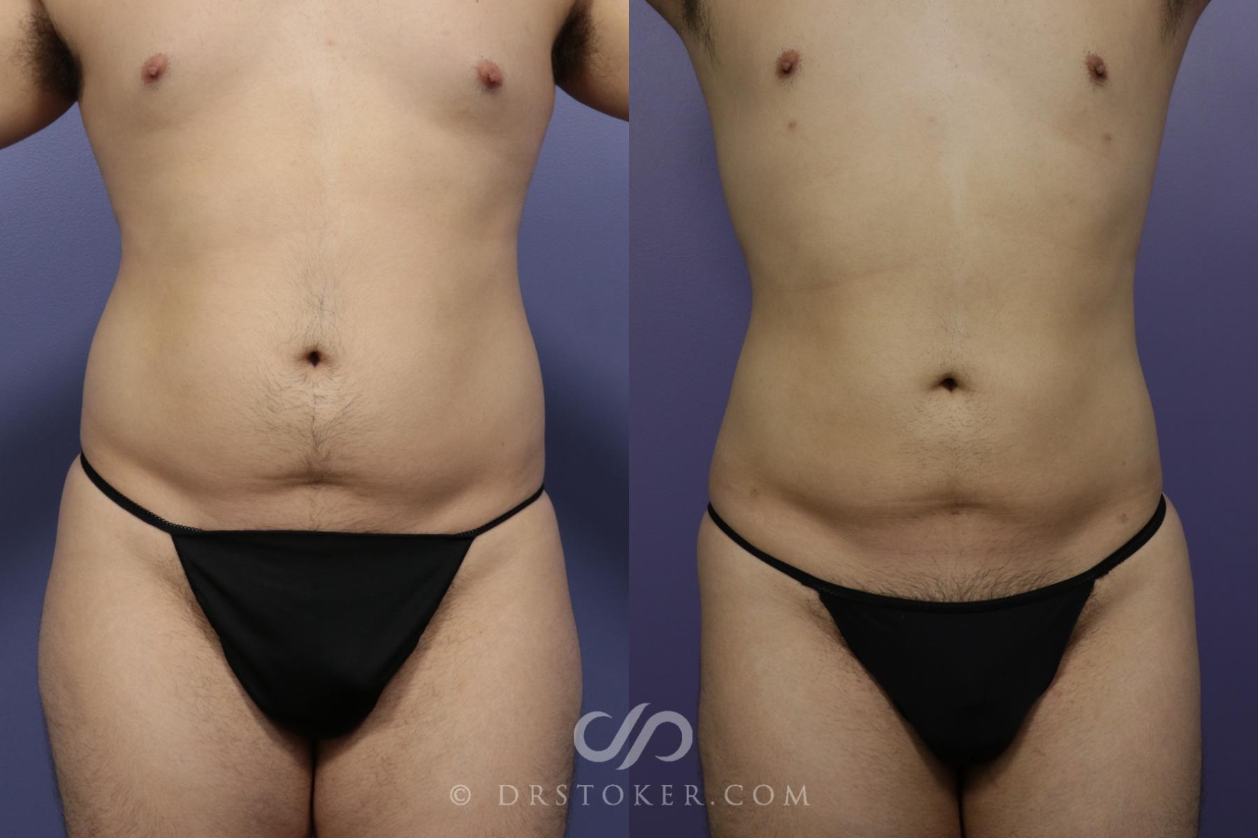 Before & After Liposuction Case 1329 View #1 View in Los Angeles, CA