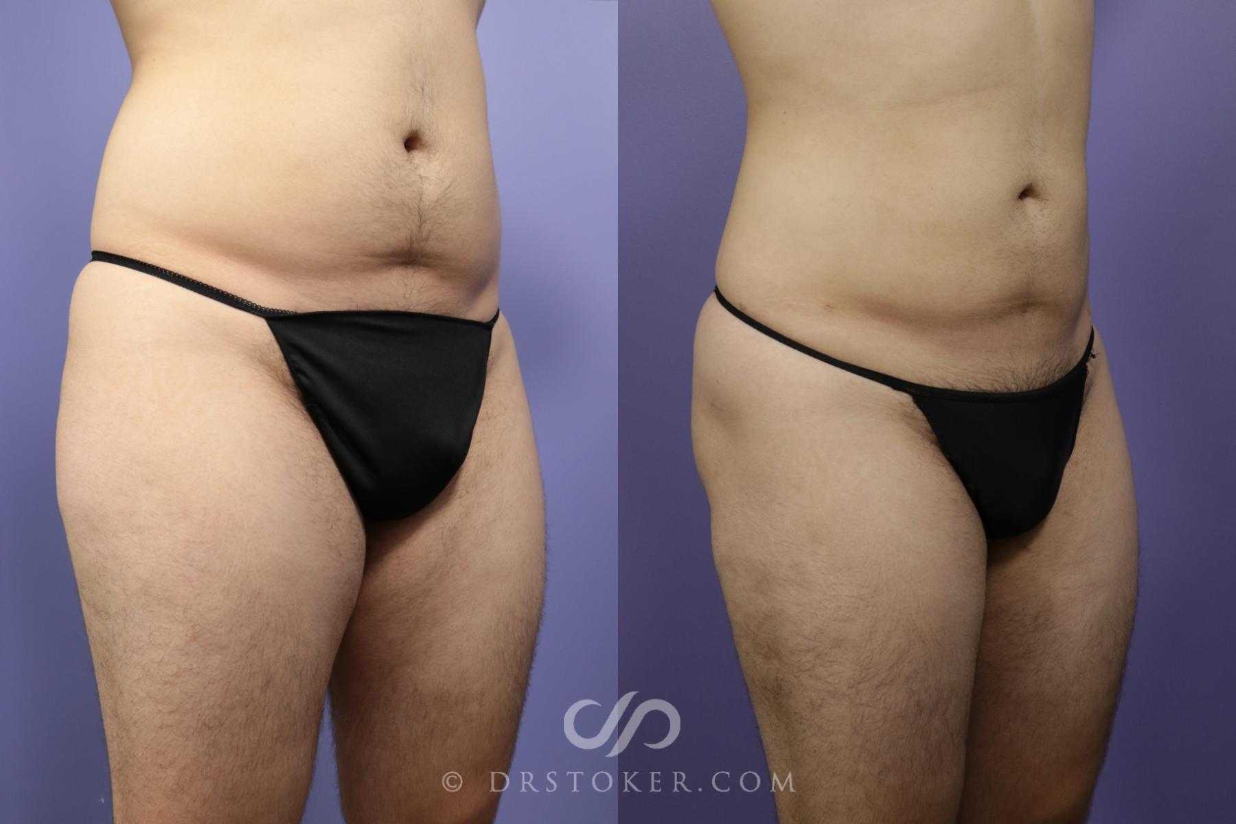 Before & After Liposuction Case 1329 View #2 View in Los Angeles, CA