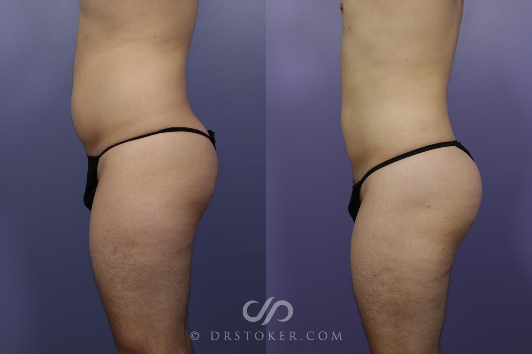 Before & After Liposuction Case 1329 View #3 View in Los Angeles, CA