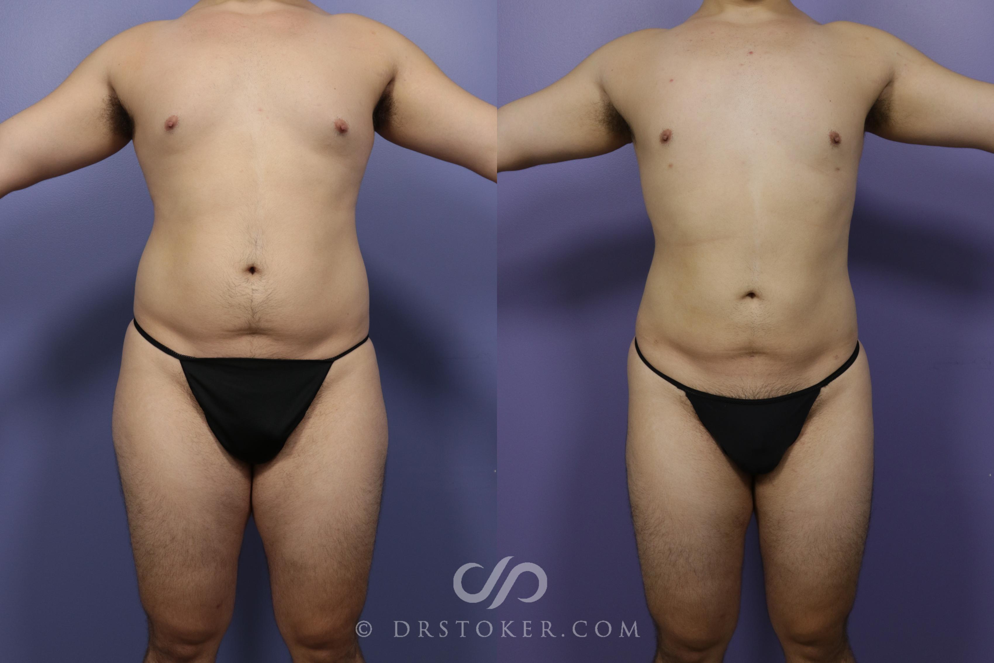 Before & After Liposuction Case 1330 View #1 View in Los Angeles, CA