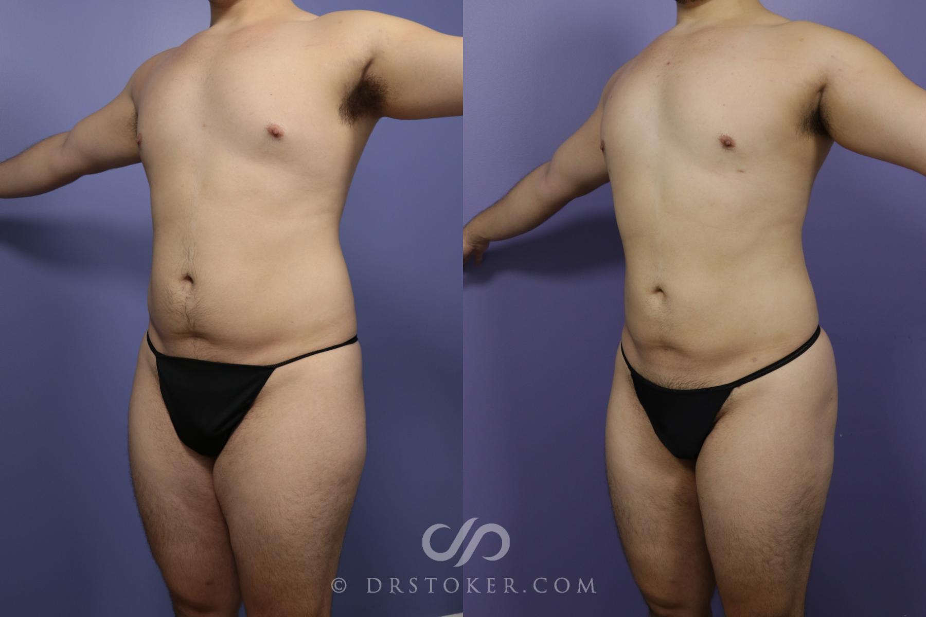 Before & After Liposuction Case 1330 View #2 View in Los Angeles, CA