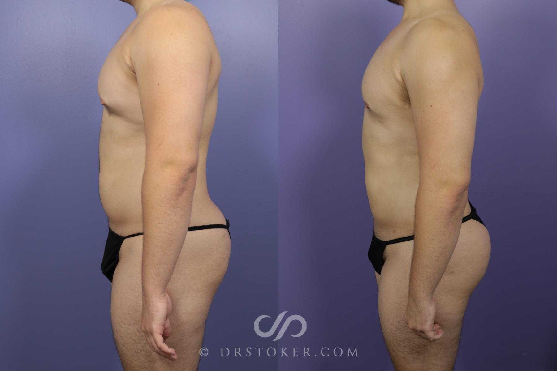 Before & After Liposuction Case 1330 View #3 View in Los Angeles, CA