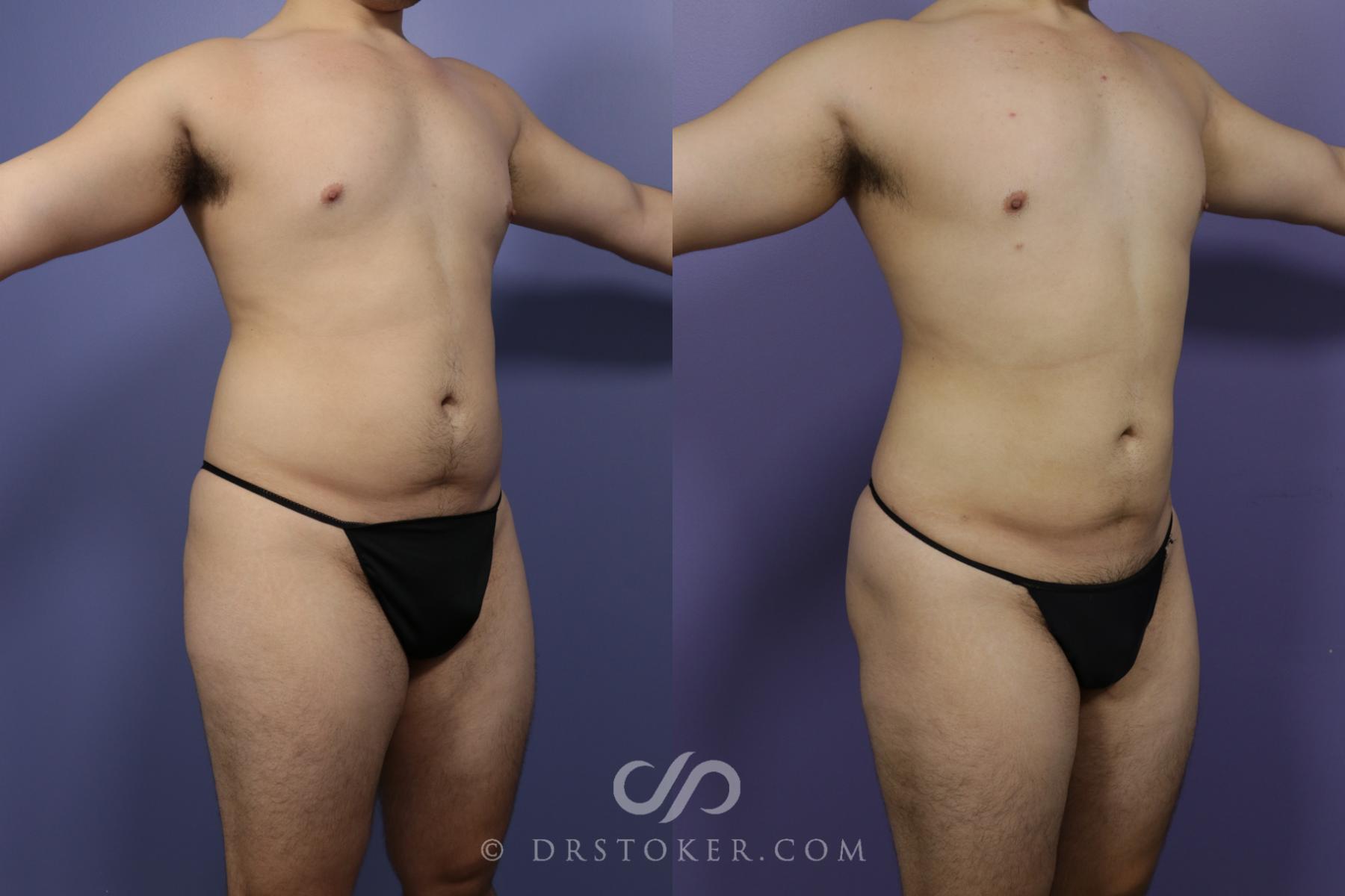 Before & After Liposuction Case 1331 View #1 View in Los Angeles, CA