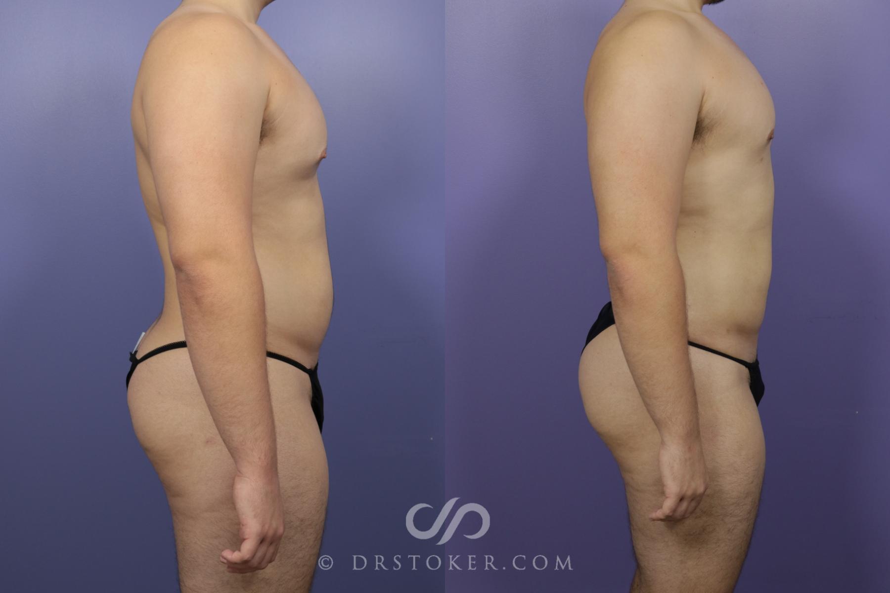 Before & After Liposuction Case 1331 View #2 View in Los Angeles, CA