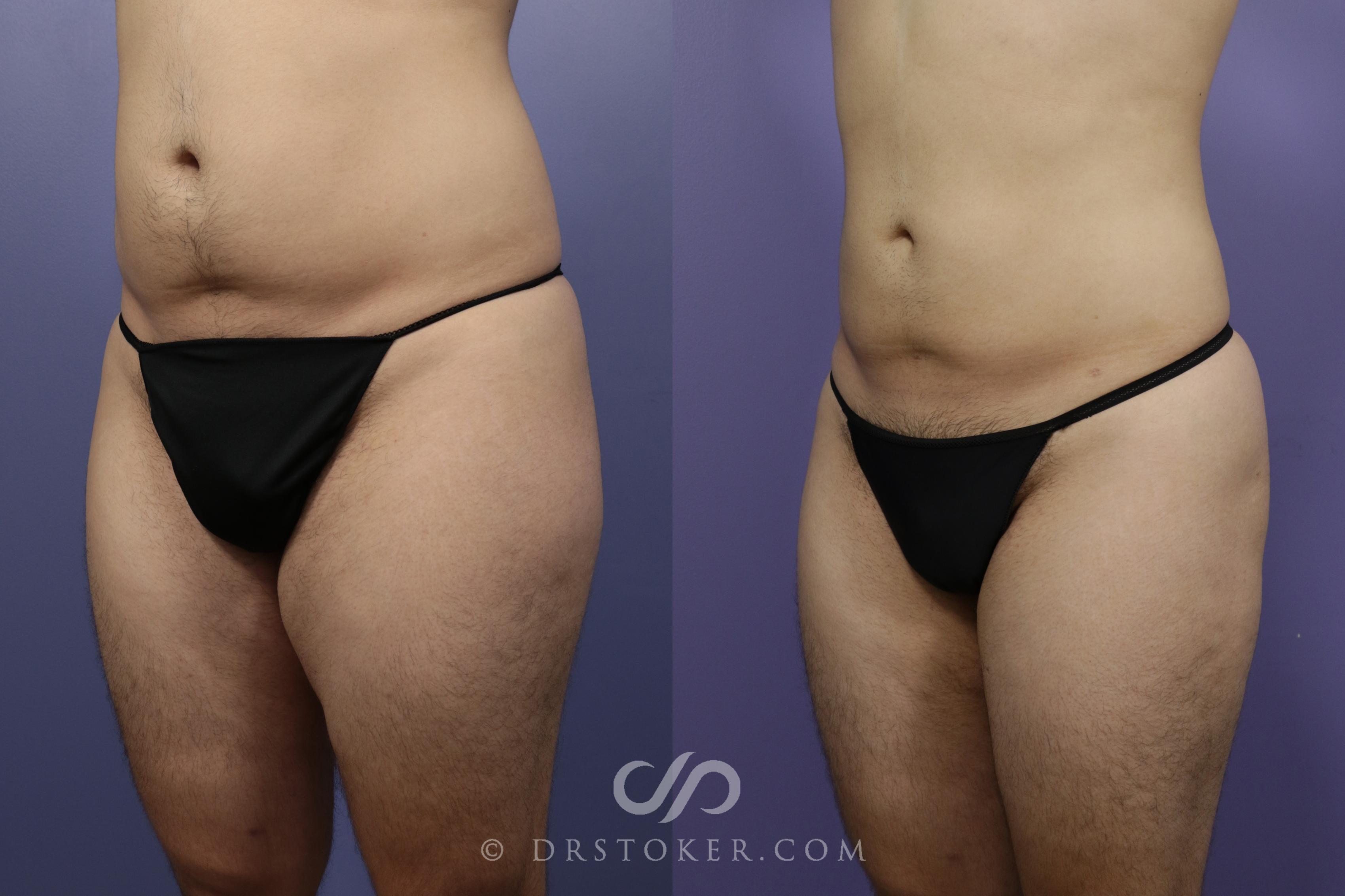 Before & After Liposuction Case 1332 View #1 View in Los Angeles, CA