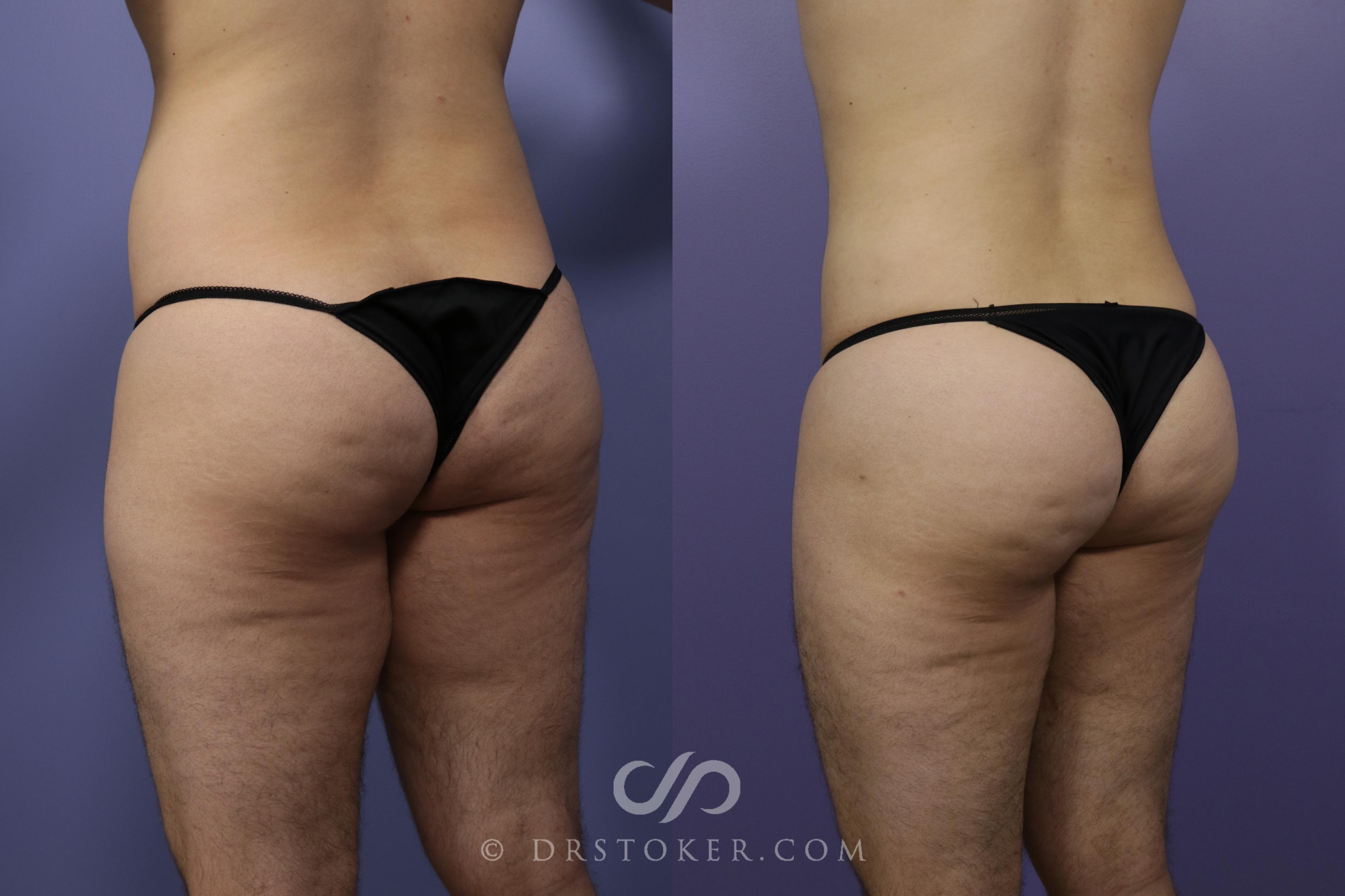 Before & After Liposuction Case 1332 View #2 View in Los Angeles, CA