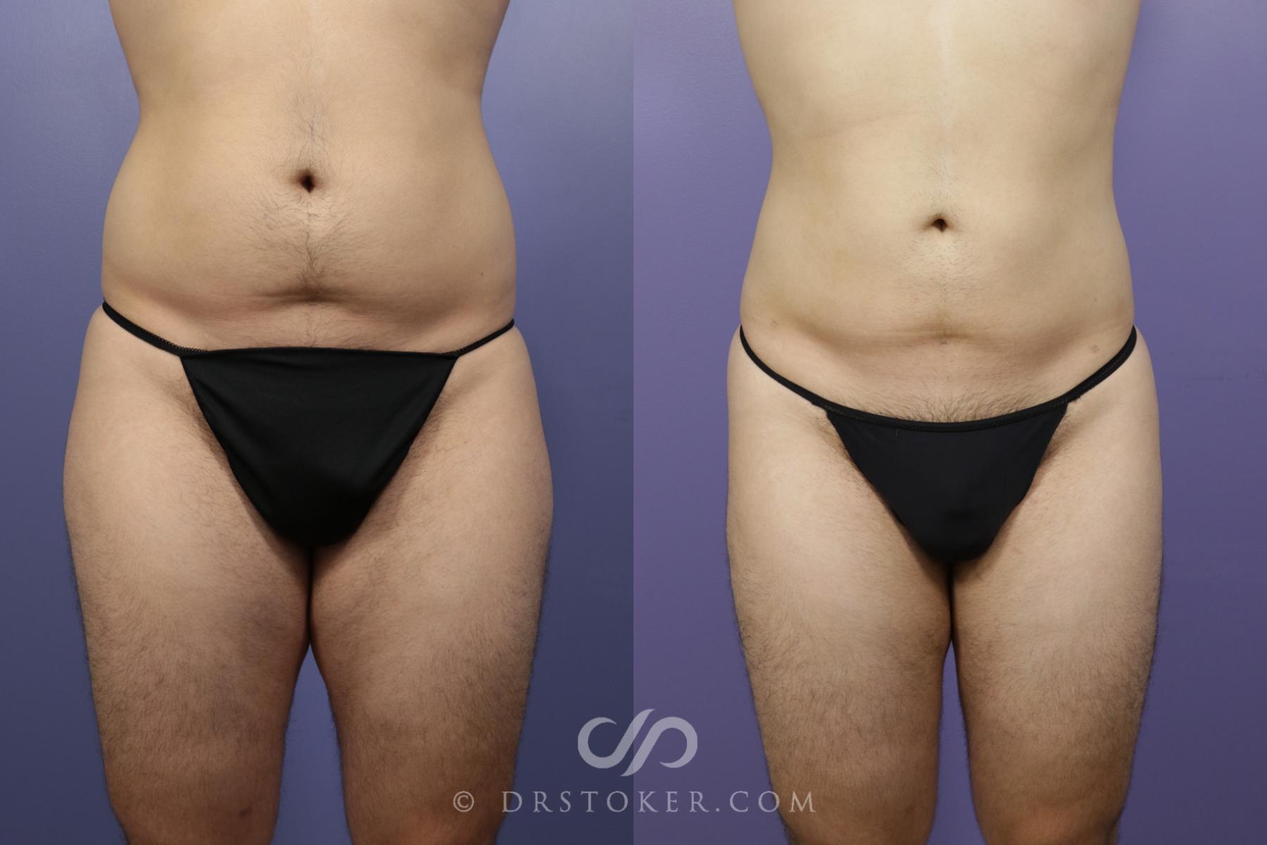 Before & After Liposuction Case 1332 View #3 View in Los Angeles, CA
