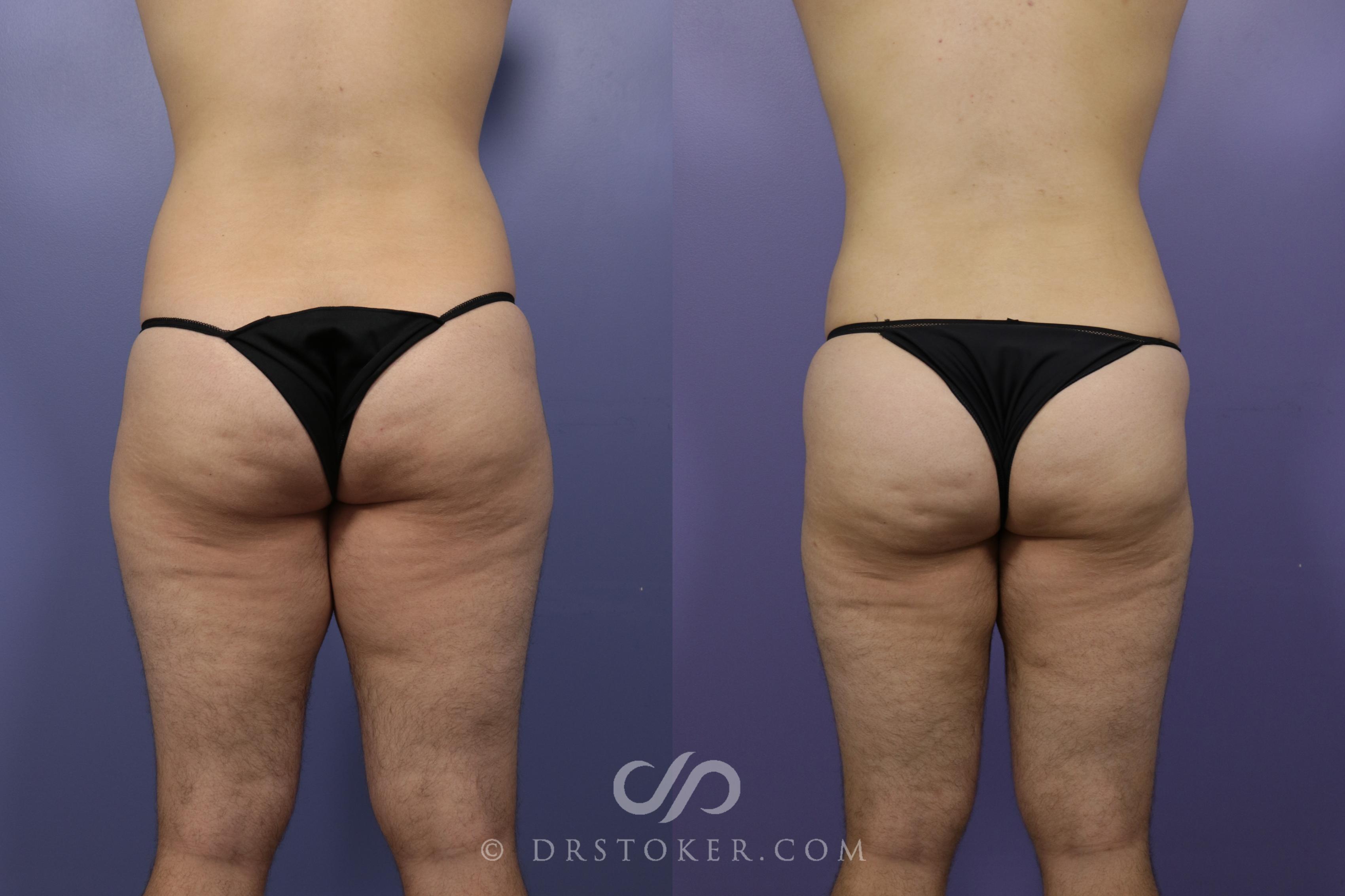 Before & After Liposuction Case 1333 View #1 View in Los Angeles, CA