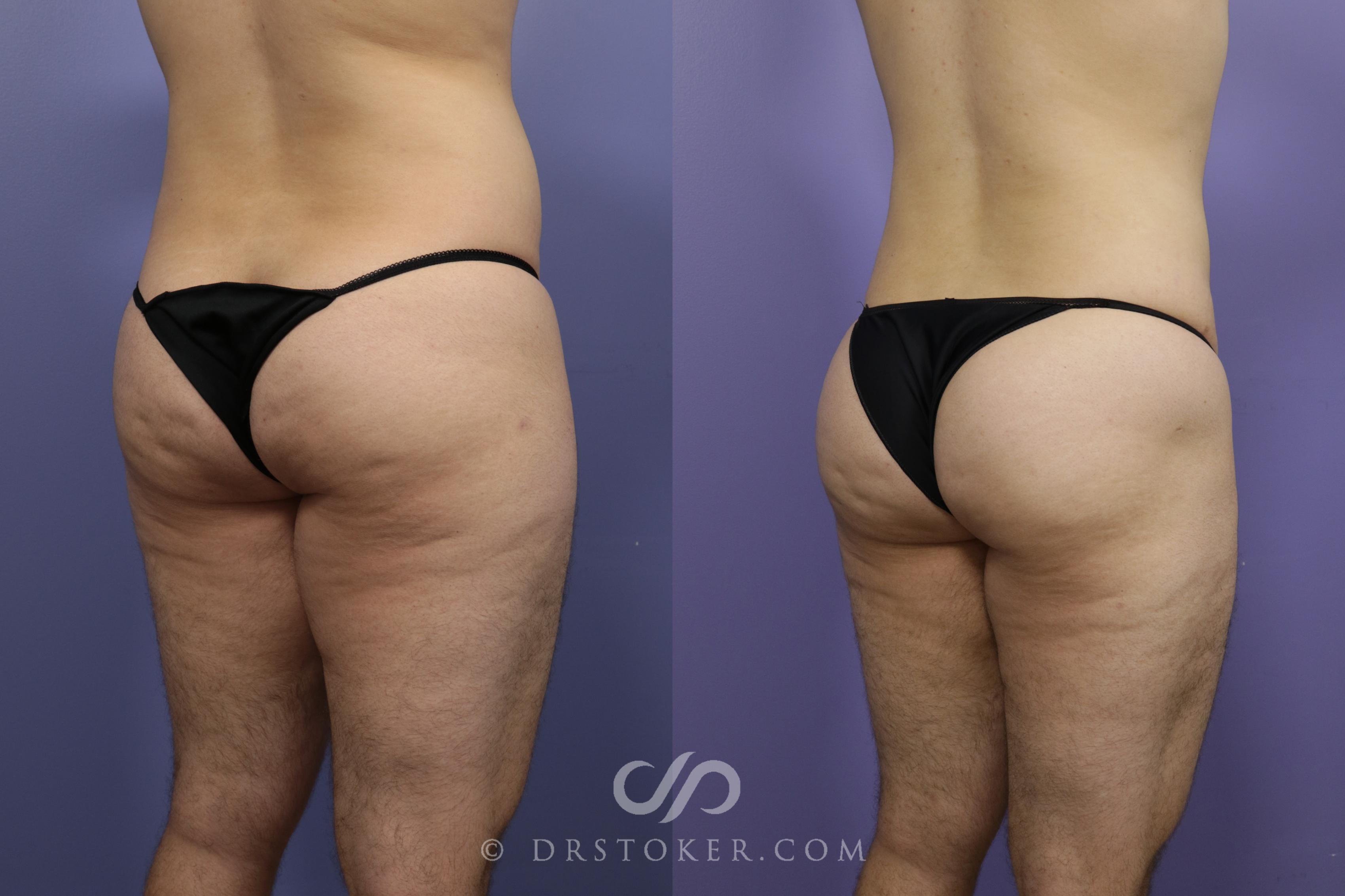 Before & After Liposuction Case 1333 View #2 View in Los Angeles, CA