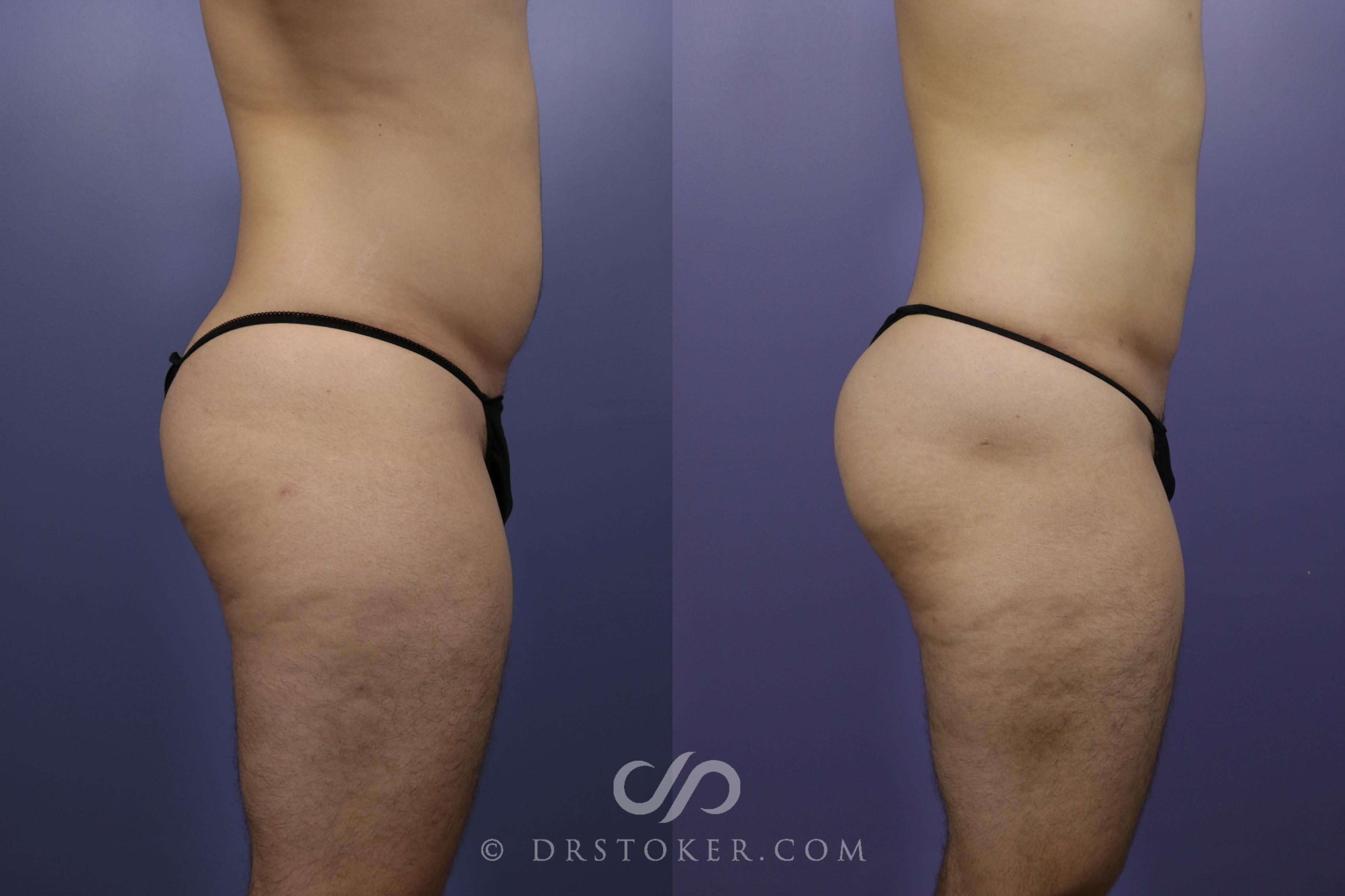 Before & After Liposuction Case 1333 View #3 View in Los Angeles, CA