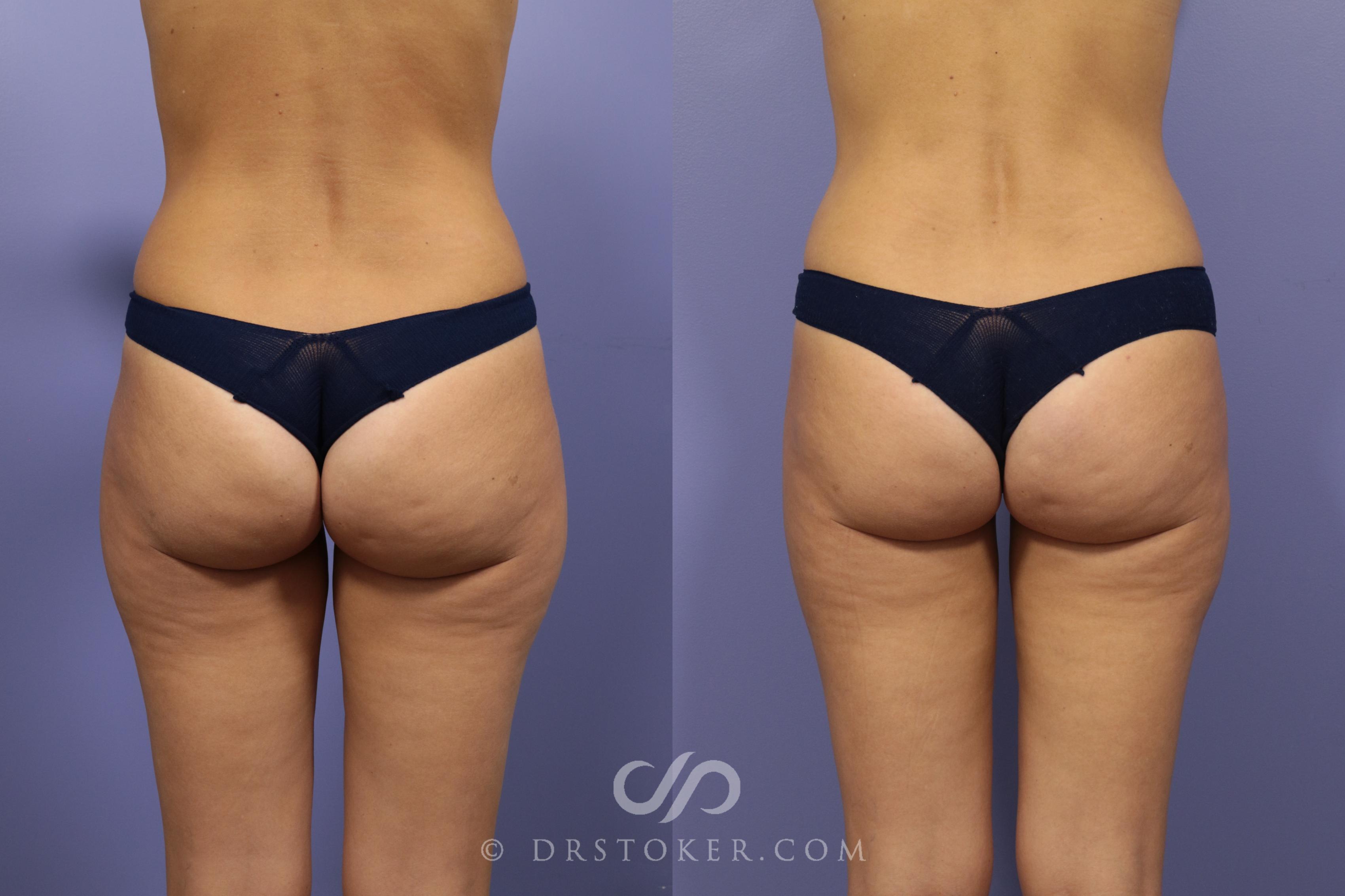Before & After Liposuction Case 1334 View #1 View in Los Angeles, CA