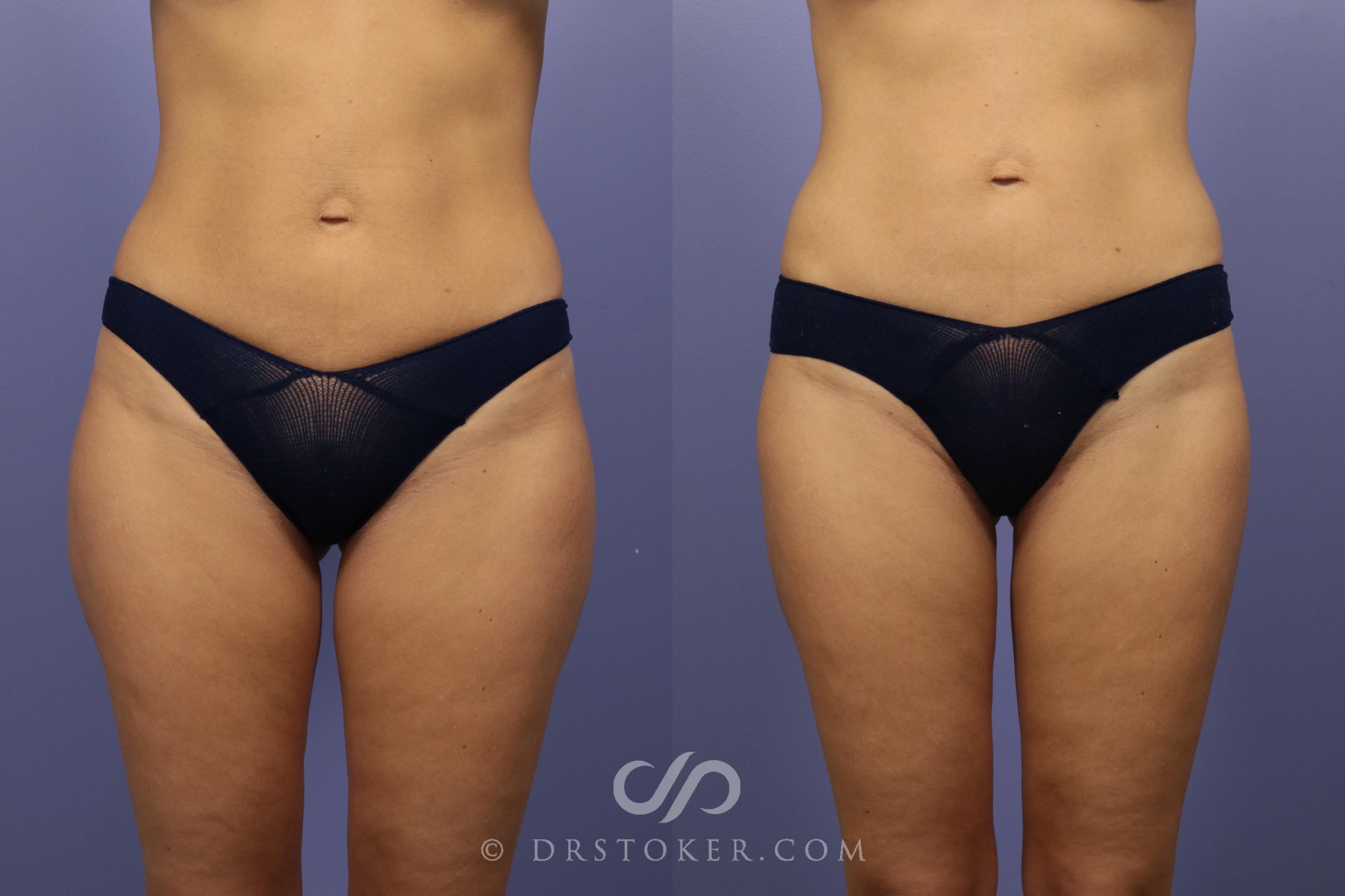 Before & After Liposuction Case 1334 View #2 View in Los Angeles, CA