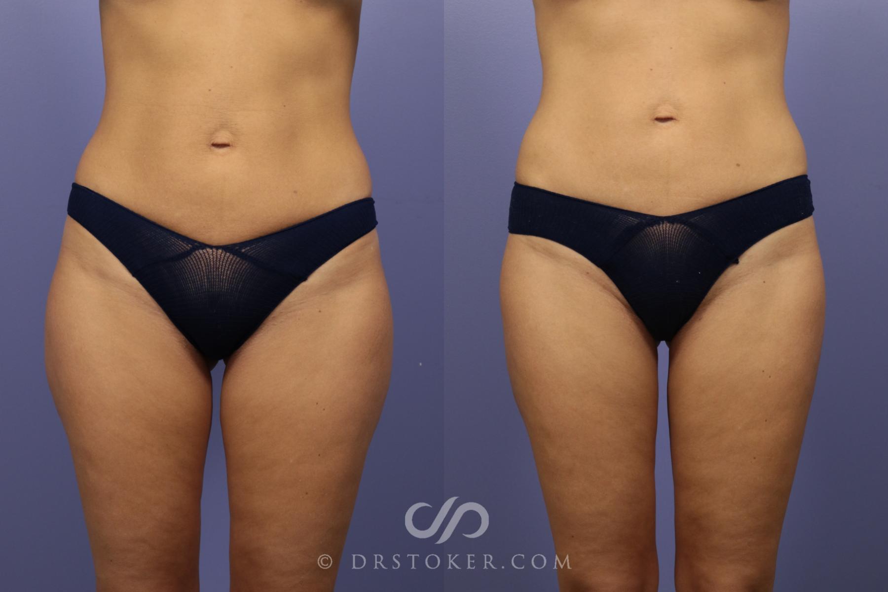Before & After Liposuction Case 1334 View #2 View in Los Angeles, CA