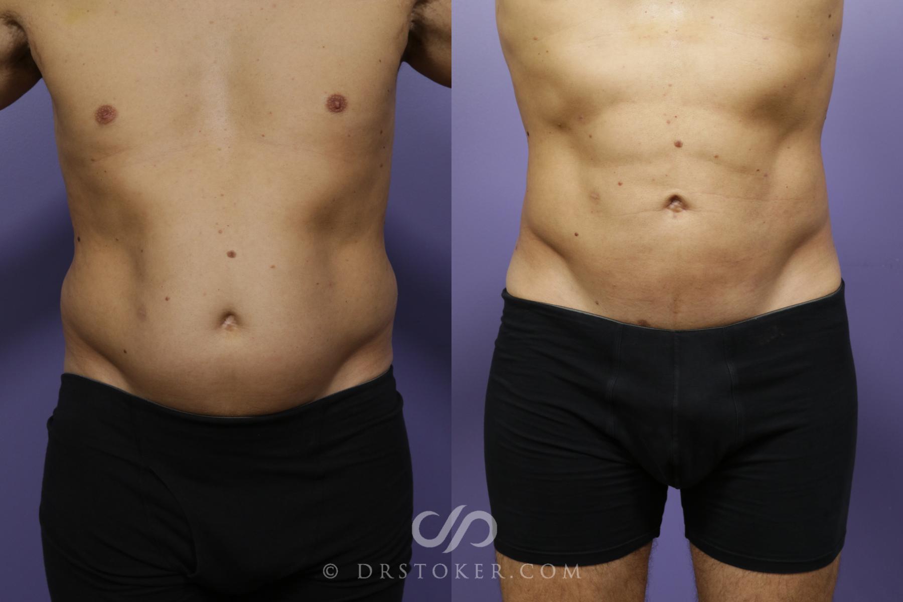 Before & After Abdominal Etching & Sculpting for Men Case 1369 View #1 View in Los Angeles, CA