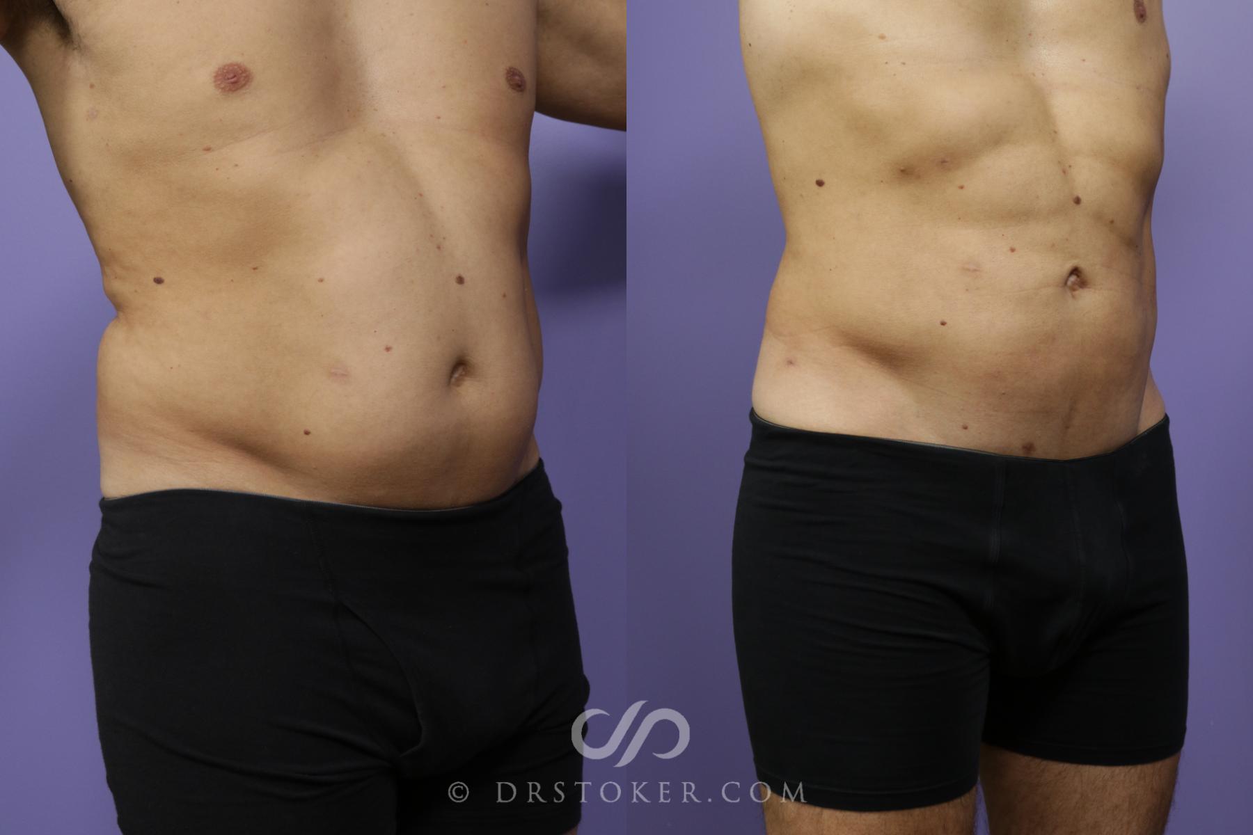 Before & After Liposuction Case 1369 View #2 View in Los Angeles, CA