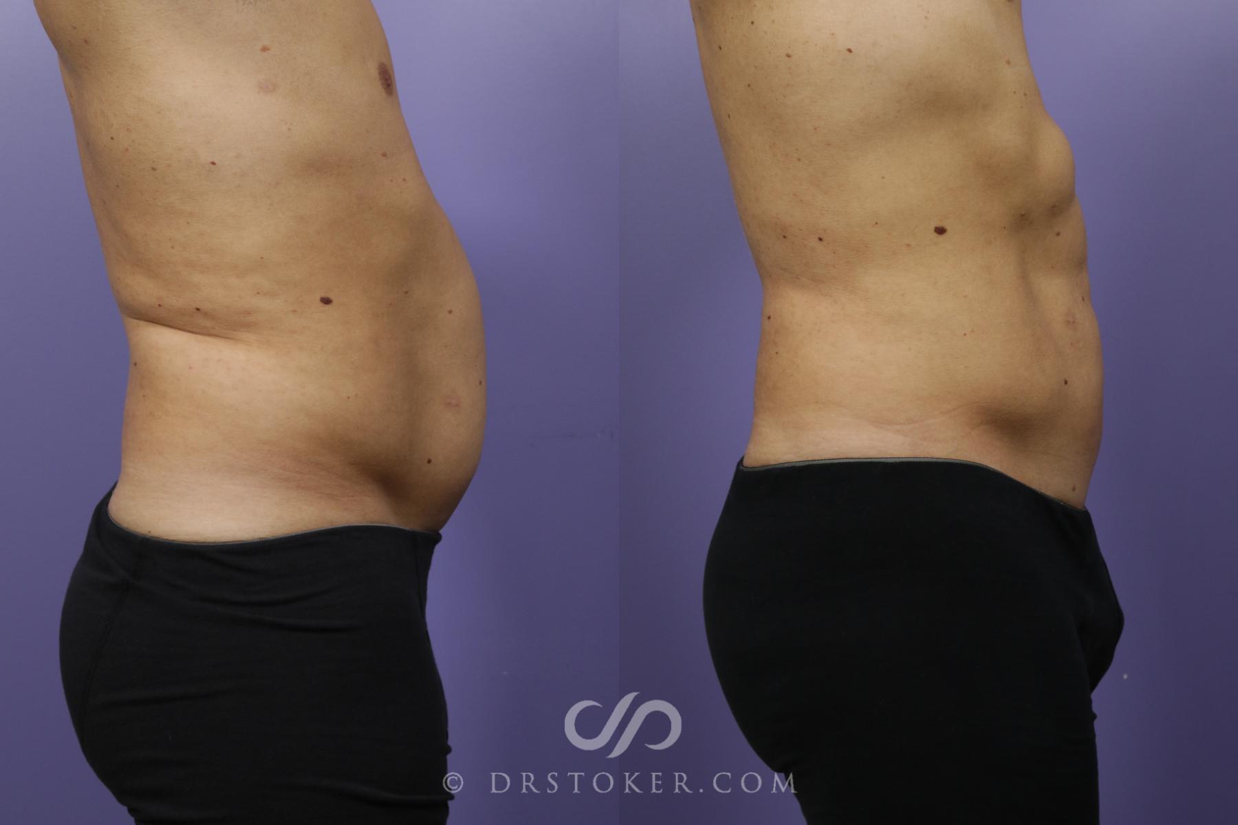 Before & After Liposuction Case 1369 View #3 View in Los Angeles, CA