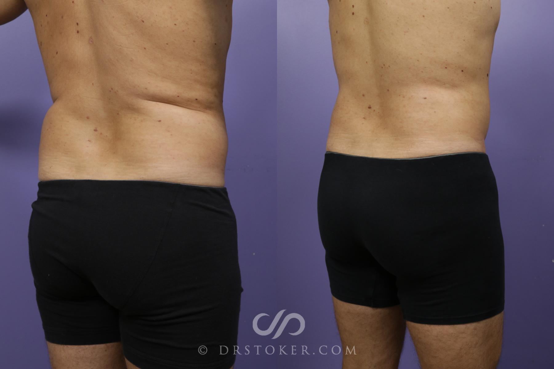 Before & After Liposuction Case 1369 View #4 View in Los Angeles, CA