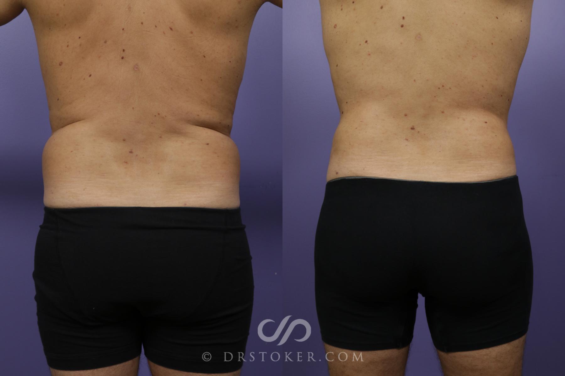 Before & After Liposuction Case 1369 View #5 View in Los Angeles, CA
