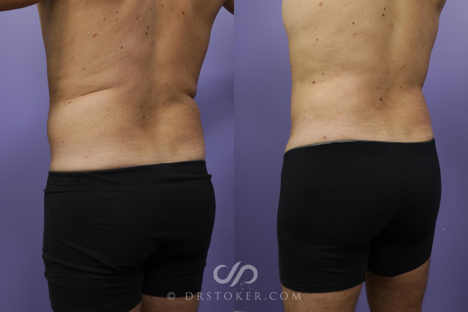 Before & After Liposuction Case 1369 View #6 View in Los Angeles, CA