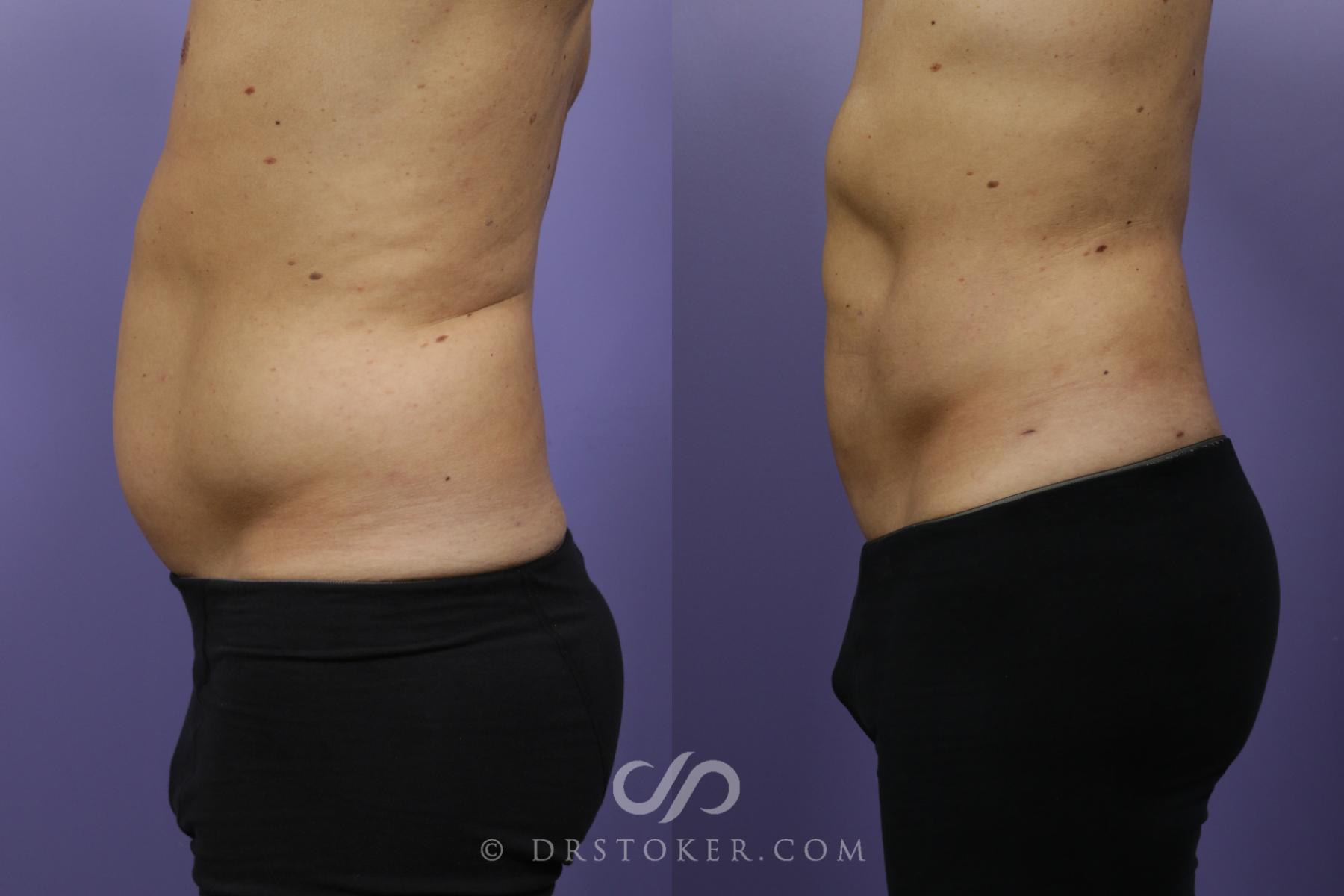 Before & After Abdominal Etching & Sculpting for Men Case 1369 View #7 View in Los Angeles, CA