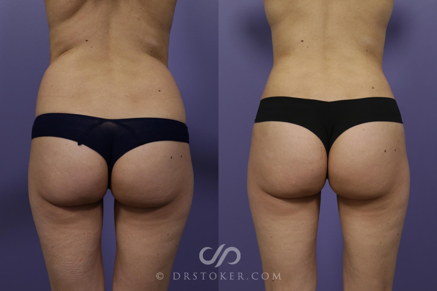 Before & After Liposuction Case 1370 View #1 View in Los Angeles, CA