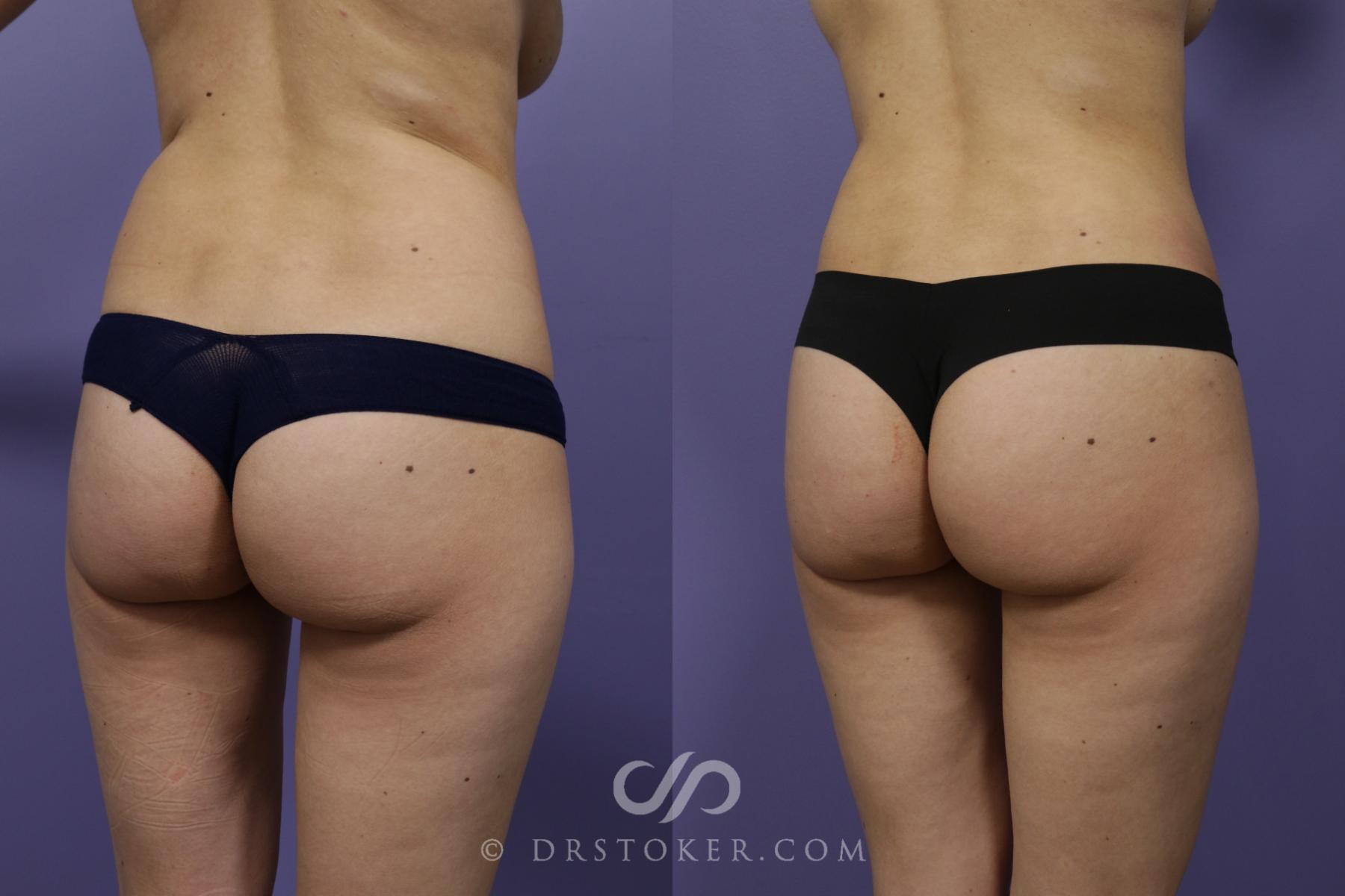 Before & After Liposuction Case 1370 View #2 View in Los Angeles, CA