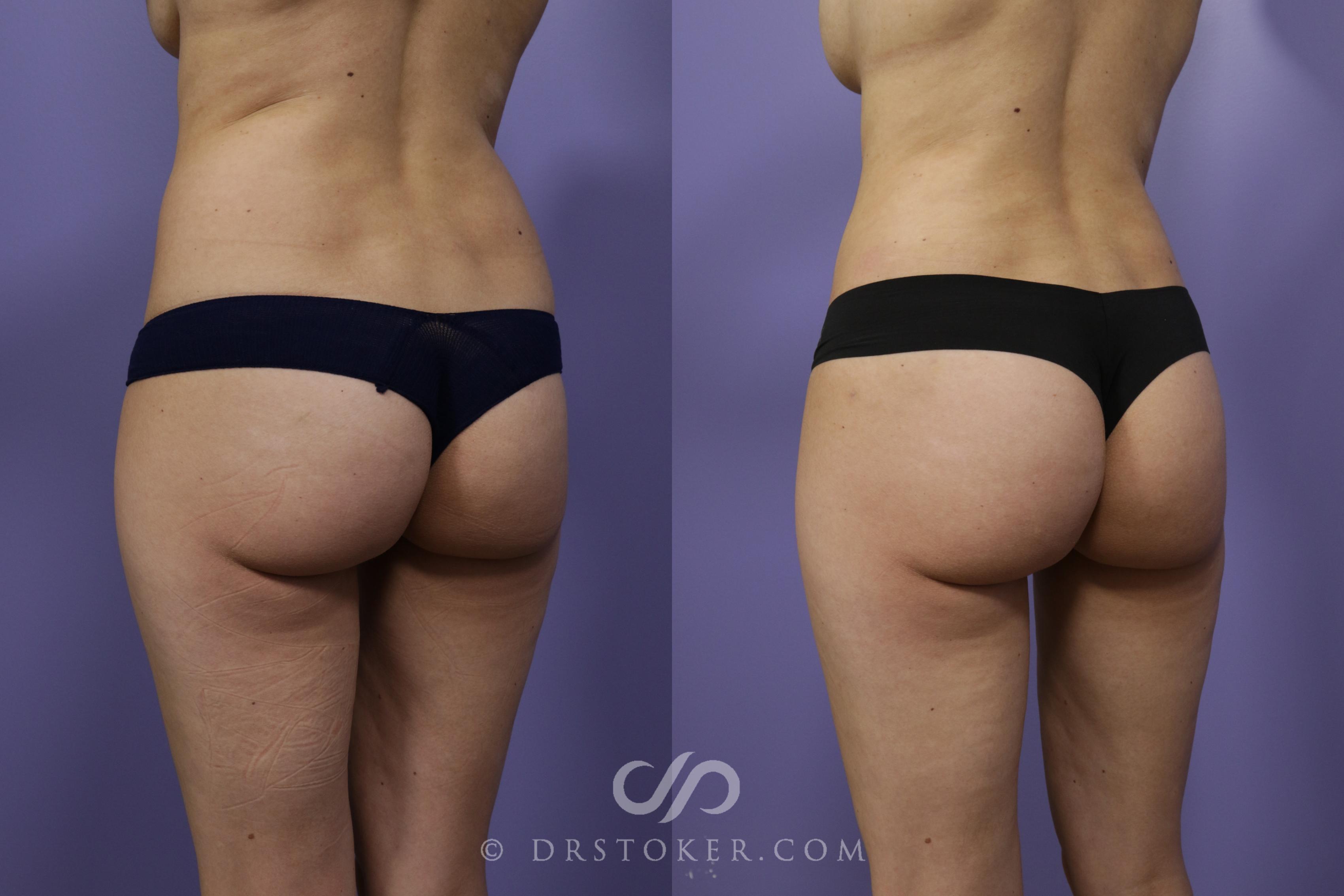 Before & After Liposuction Case 1370 View #3 View in Los Angeles, CA